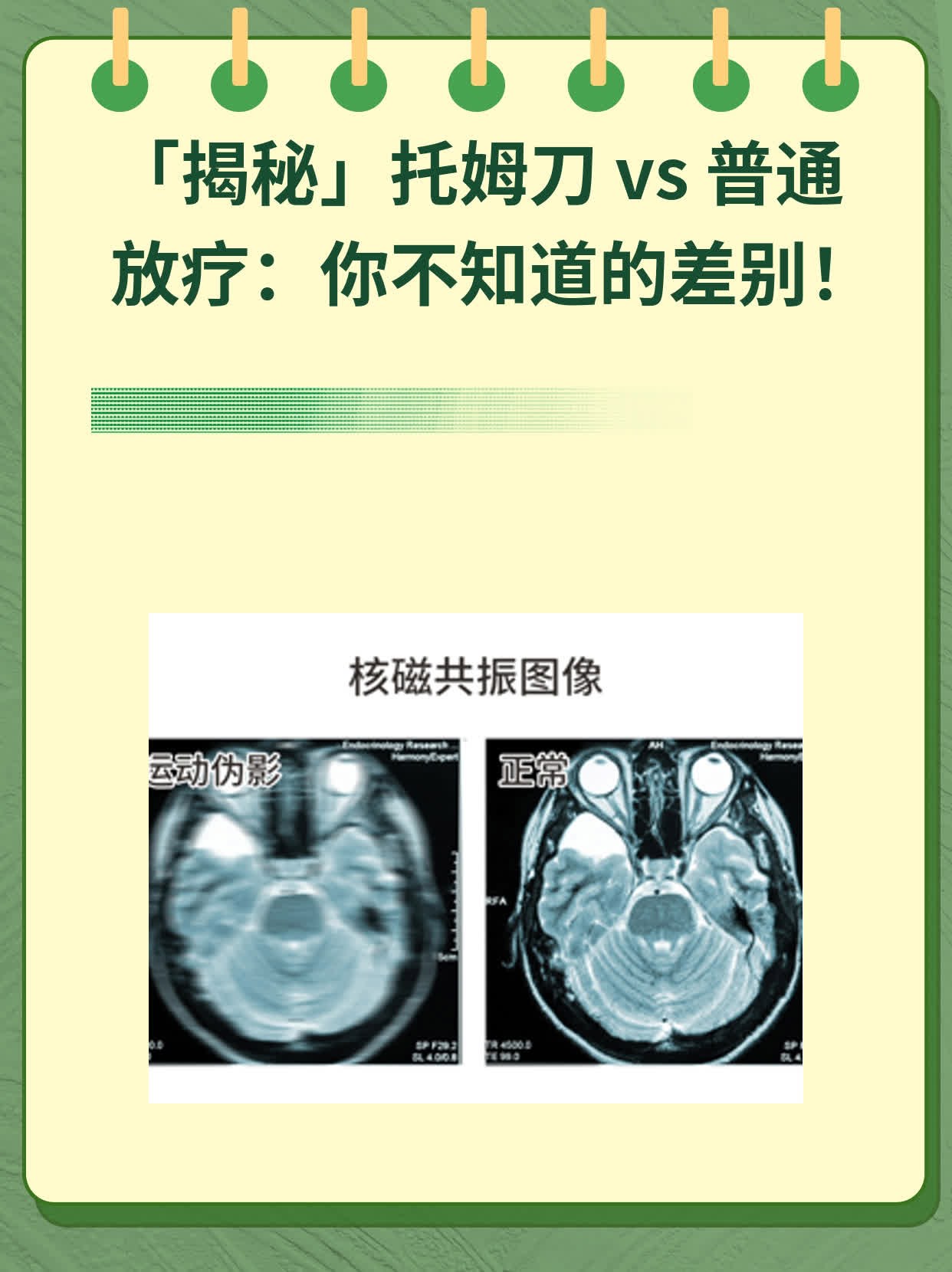 「揭秘」托姆刀 vs 普通放疗：你不知道的差别！