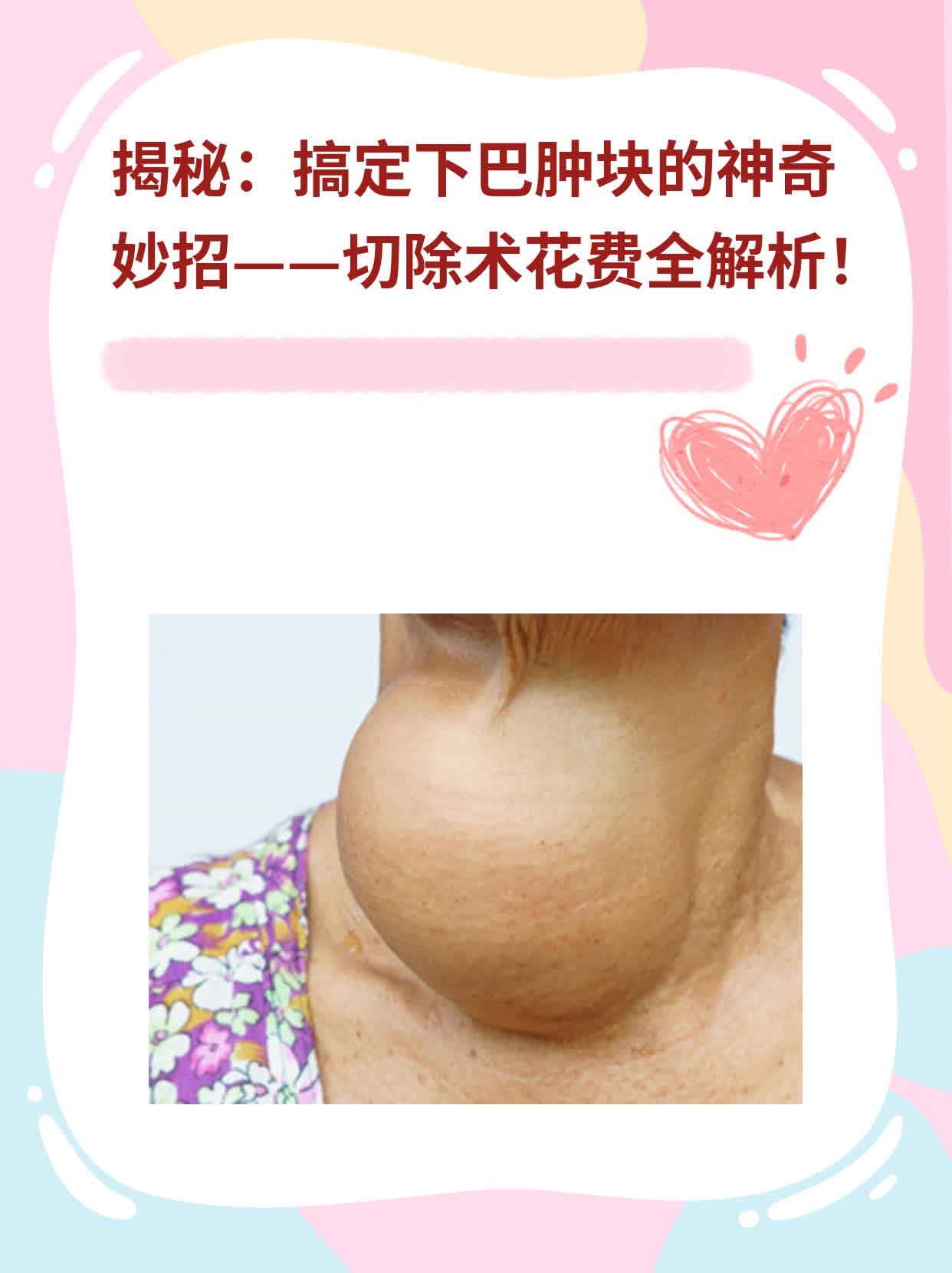 揭秘：搞定下巴肿块的神奇妙招——切除术花费全解析！
