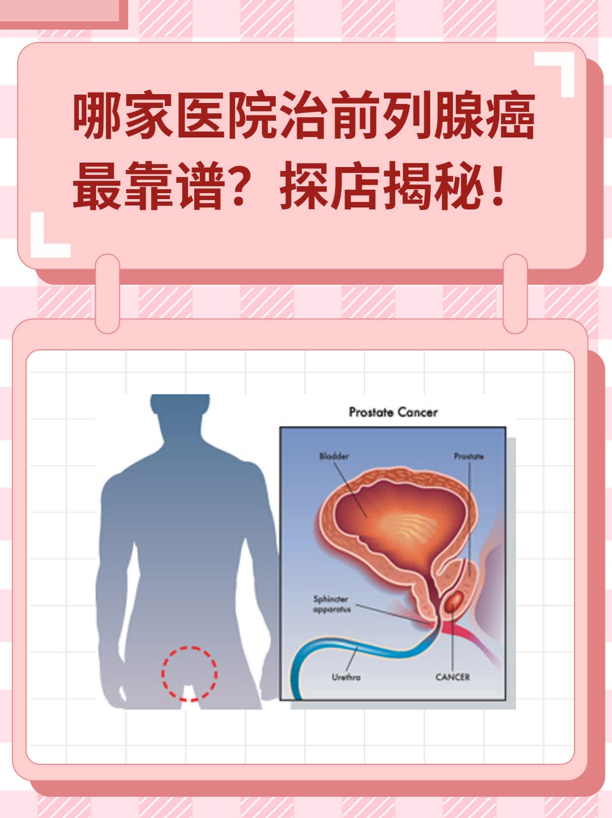 👍哪家医院治前列腺癌最靠谱？探店揭秘！🛏️