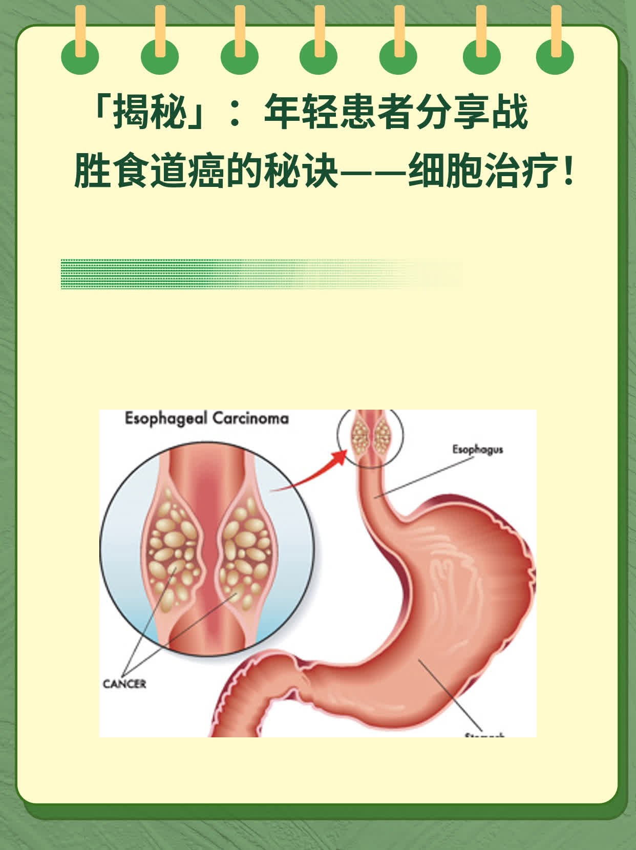 🙏「揭秘」：年轻患者分享战胜食道癌的秘诀——细胞治疗！💊