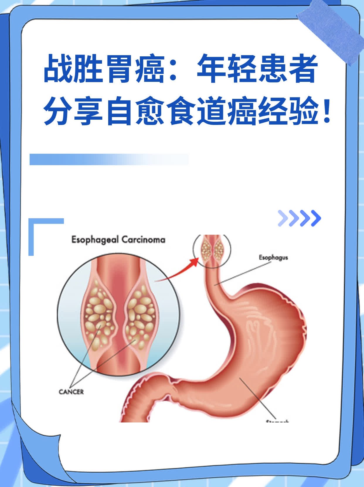 🌟战胜胃癌：年轻患者分享自愈食道癌经验！✨