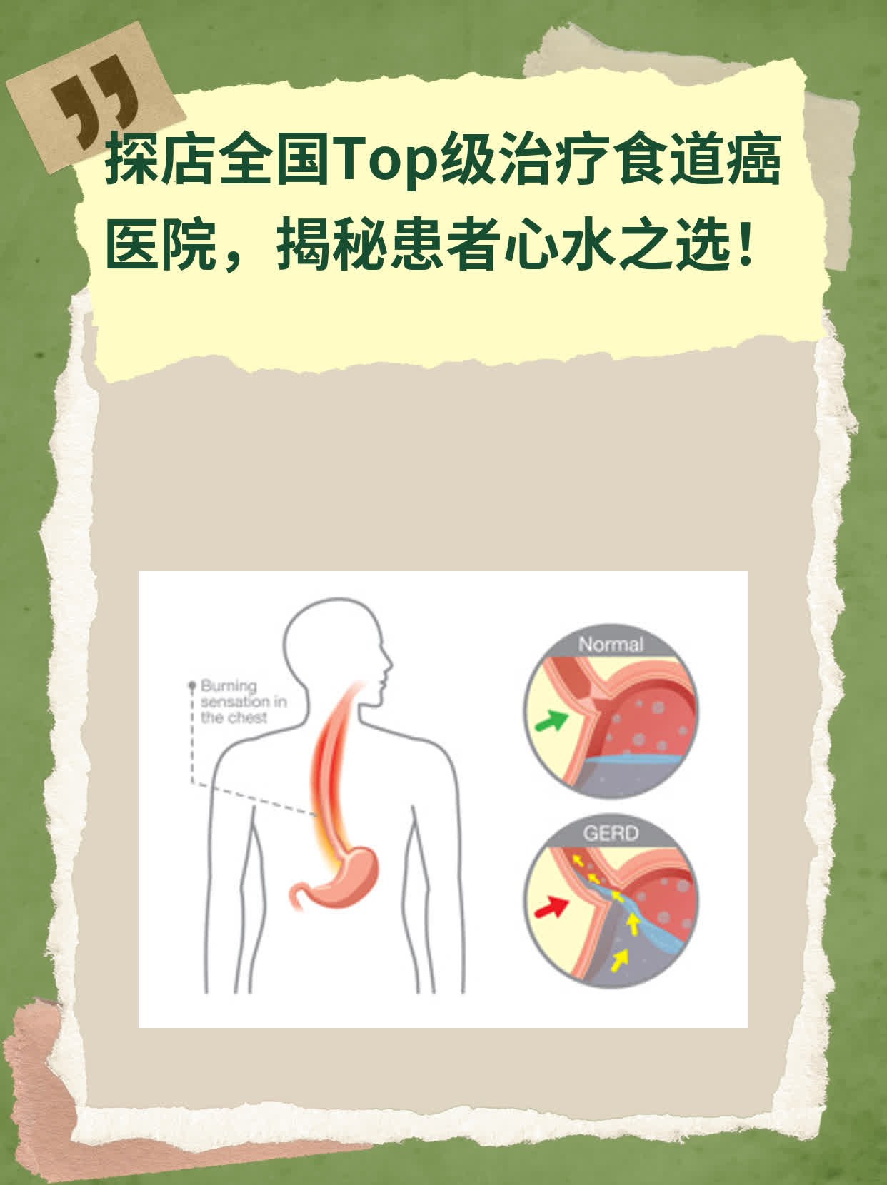 🏃探店全国Top级治疗食道癌医院，揭秘患者心水之选！❗️