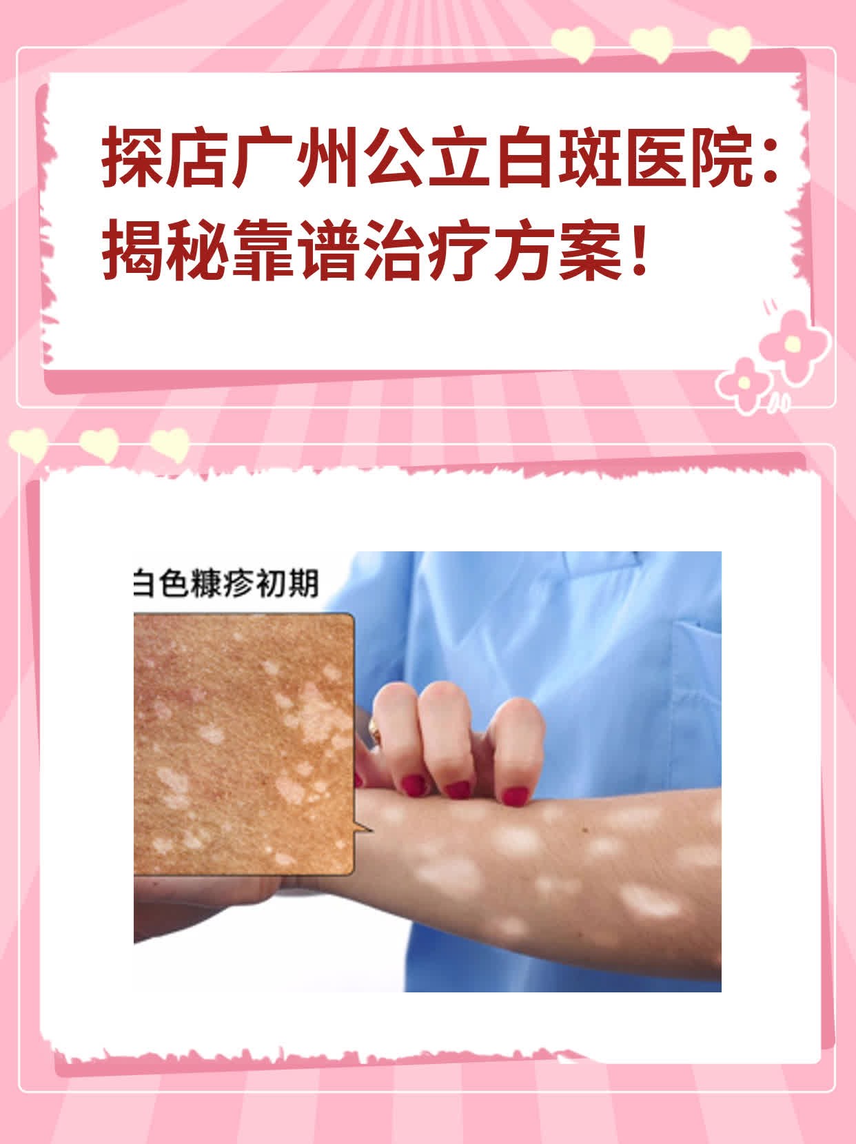 ✨探店广州公立白斑医院：揭秘靠谱治疗方案！💖