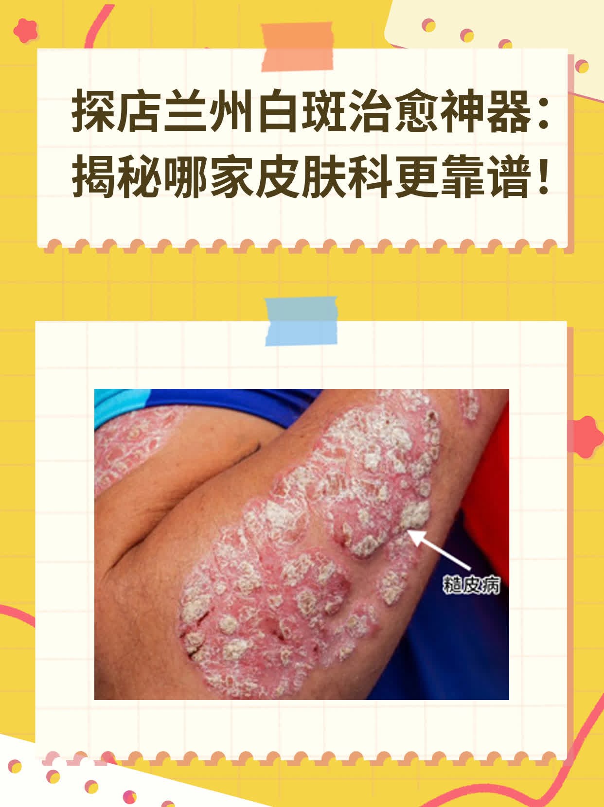 ✅探店兰州白斑治愈神器：揭秘哪家皮肤科更靠谱！💪