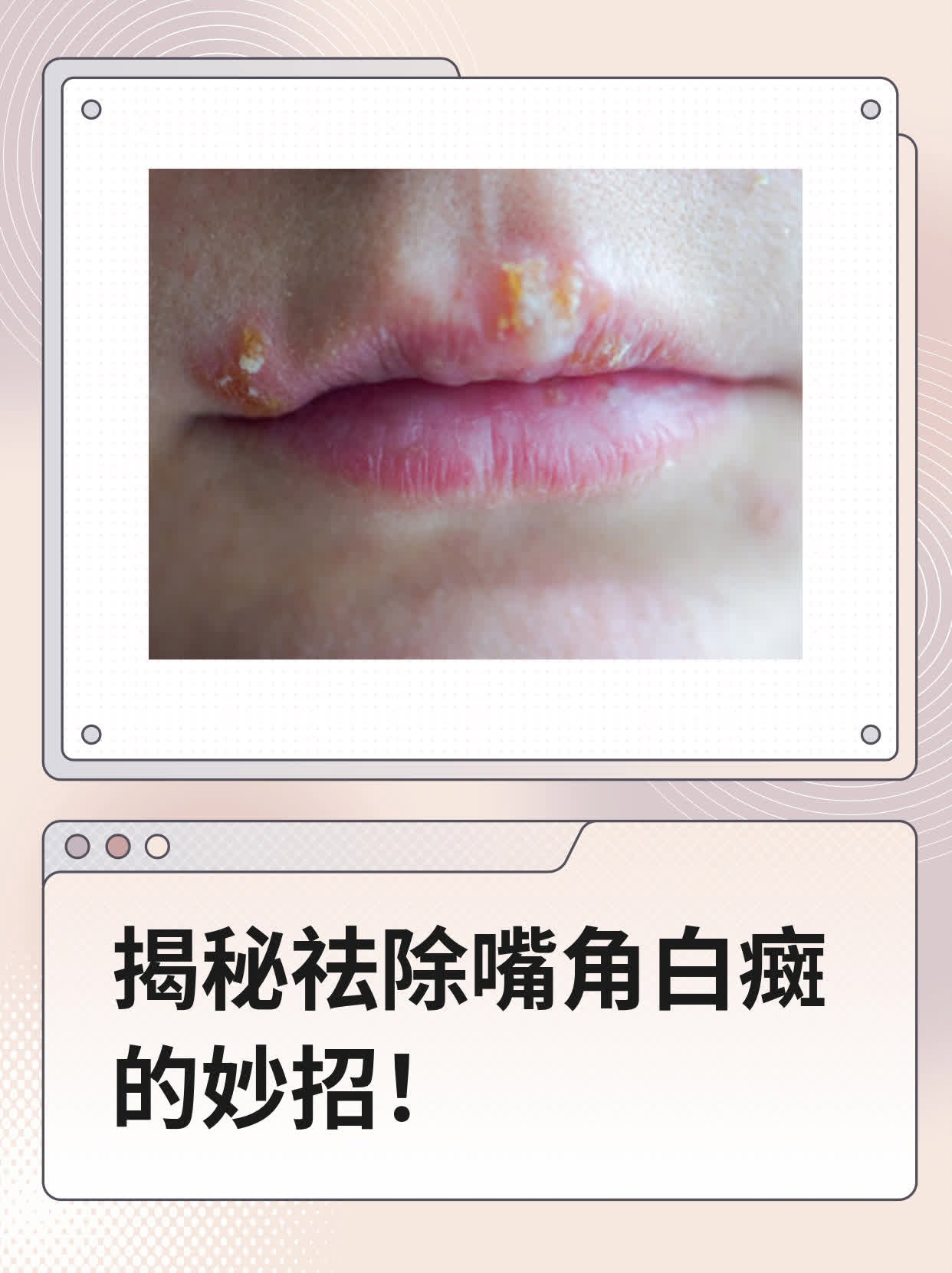 🍎揭秘祛除嘴角白癍的妙招！🏃