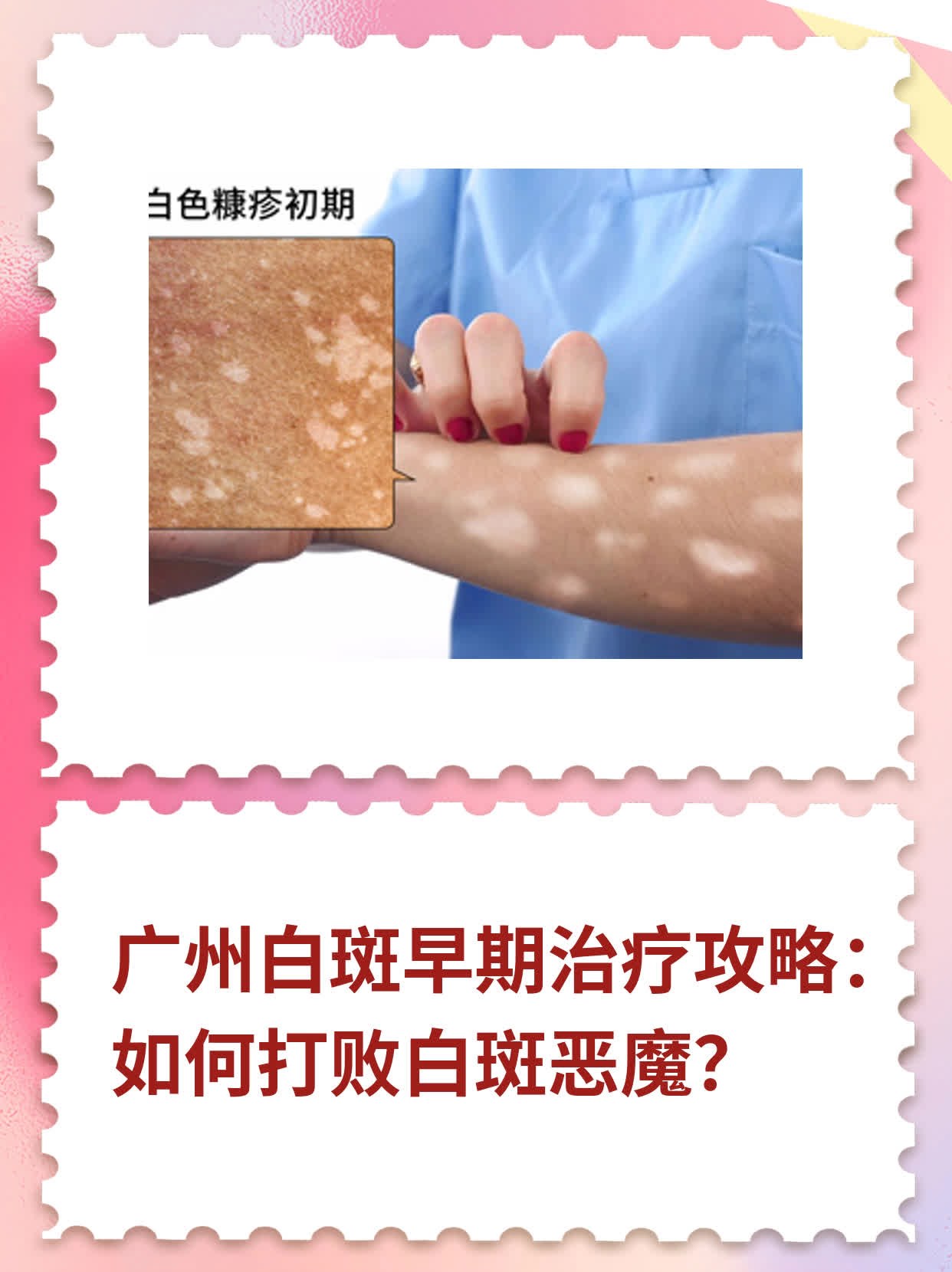 🙏广州白斑早期治疗攻略：如何打败白斑恶魔？💊