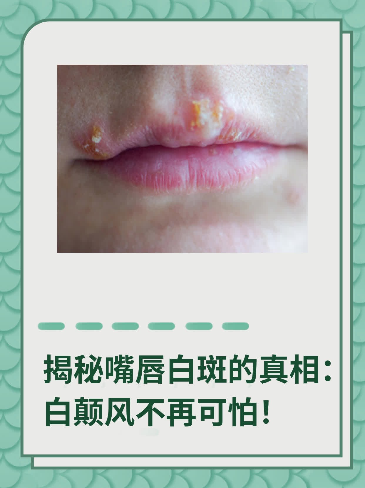 ❗️揭秘嘴唇白斑的真相：白颠风不再可怕！✅