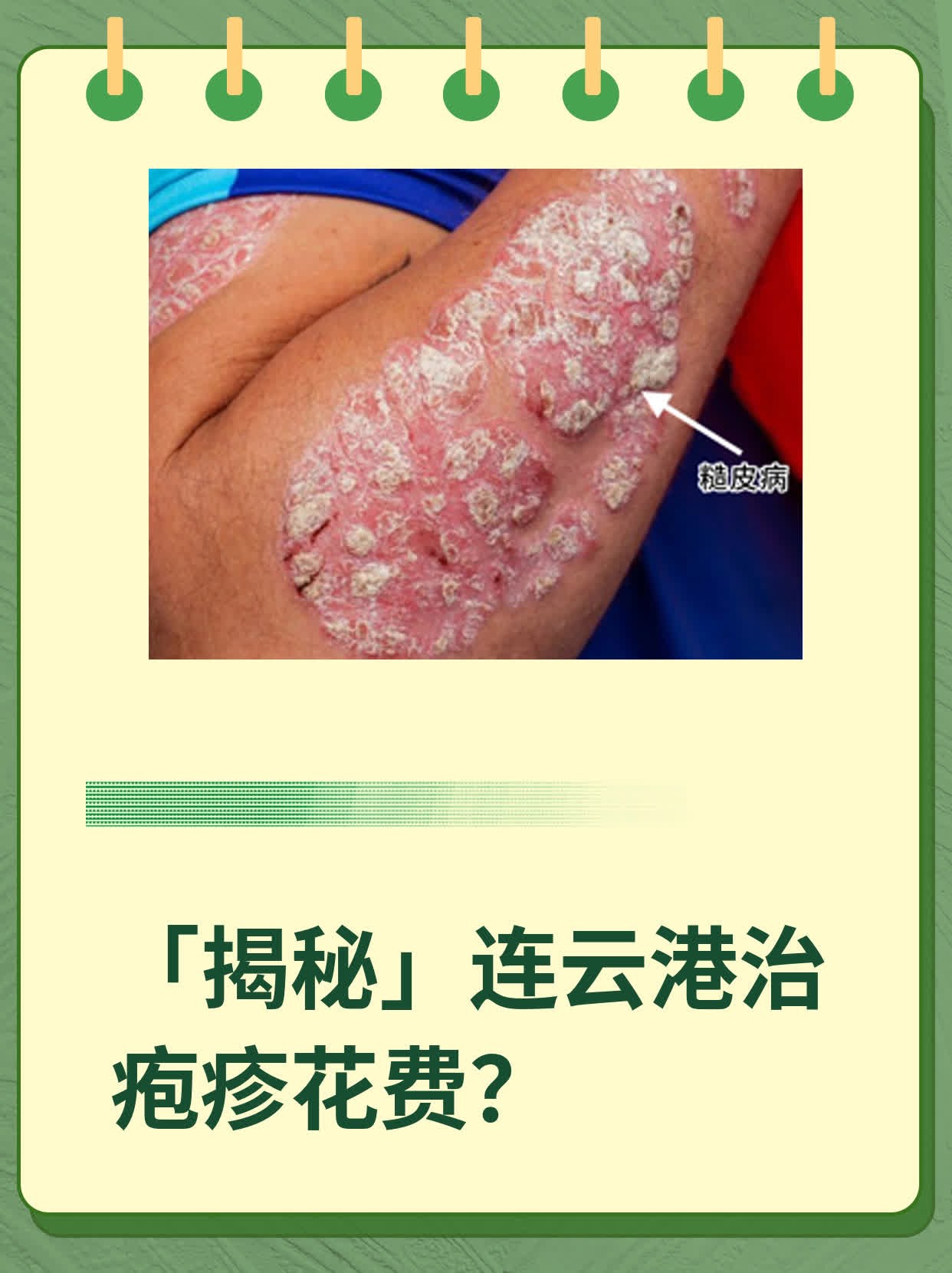 💪「揭秘」连云港治疱疹花费？💖
