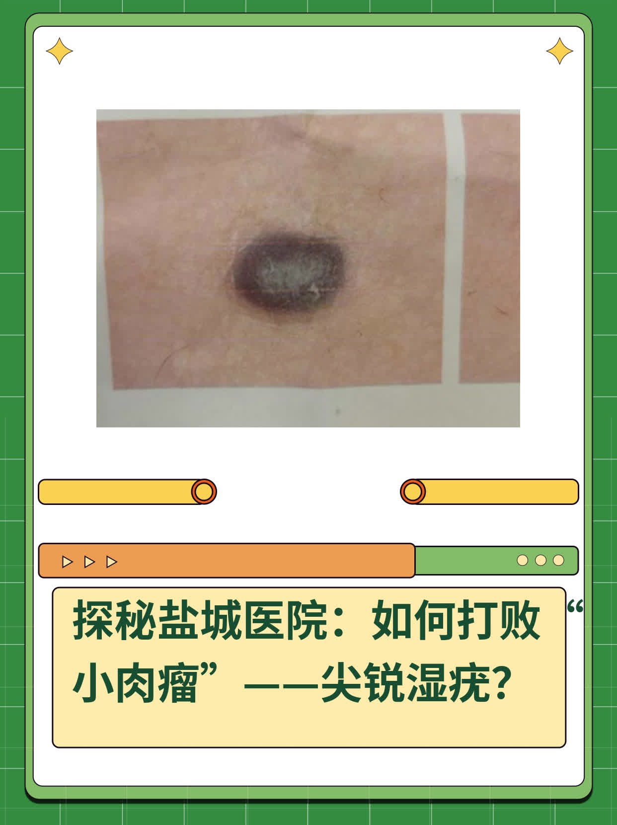 💖探秘盐城医院：如何打败“小肉瘤”——尖锐湿疣？📈