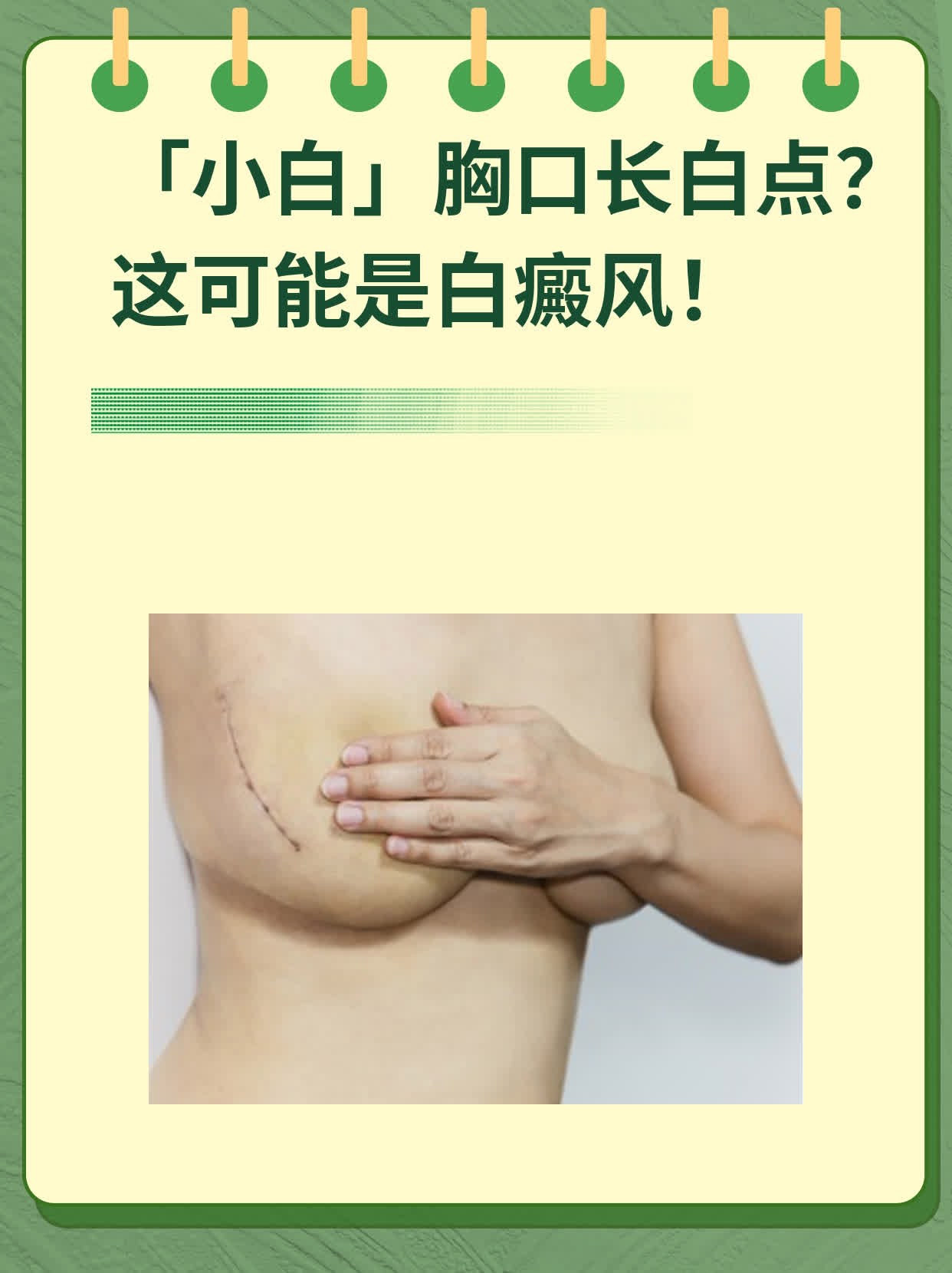 👍「小白」胸口长白点？这可能是白癜风！🛏️