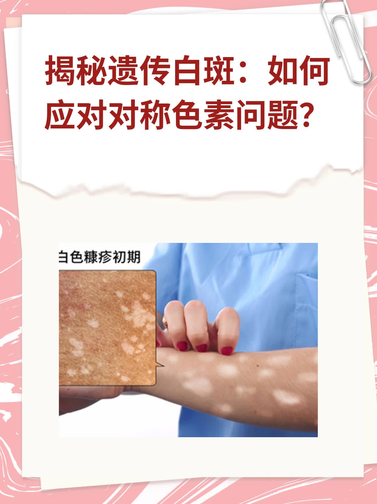 👍揭秘遗传白斑：如何应对对称色素问题？🛏️