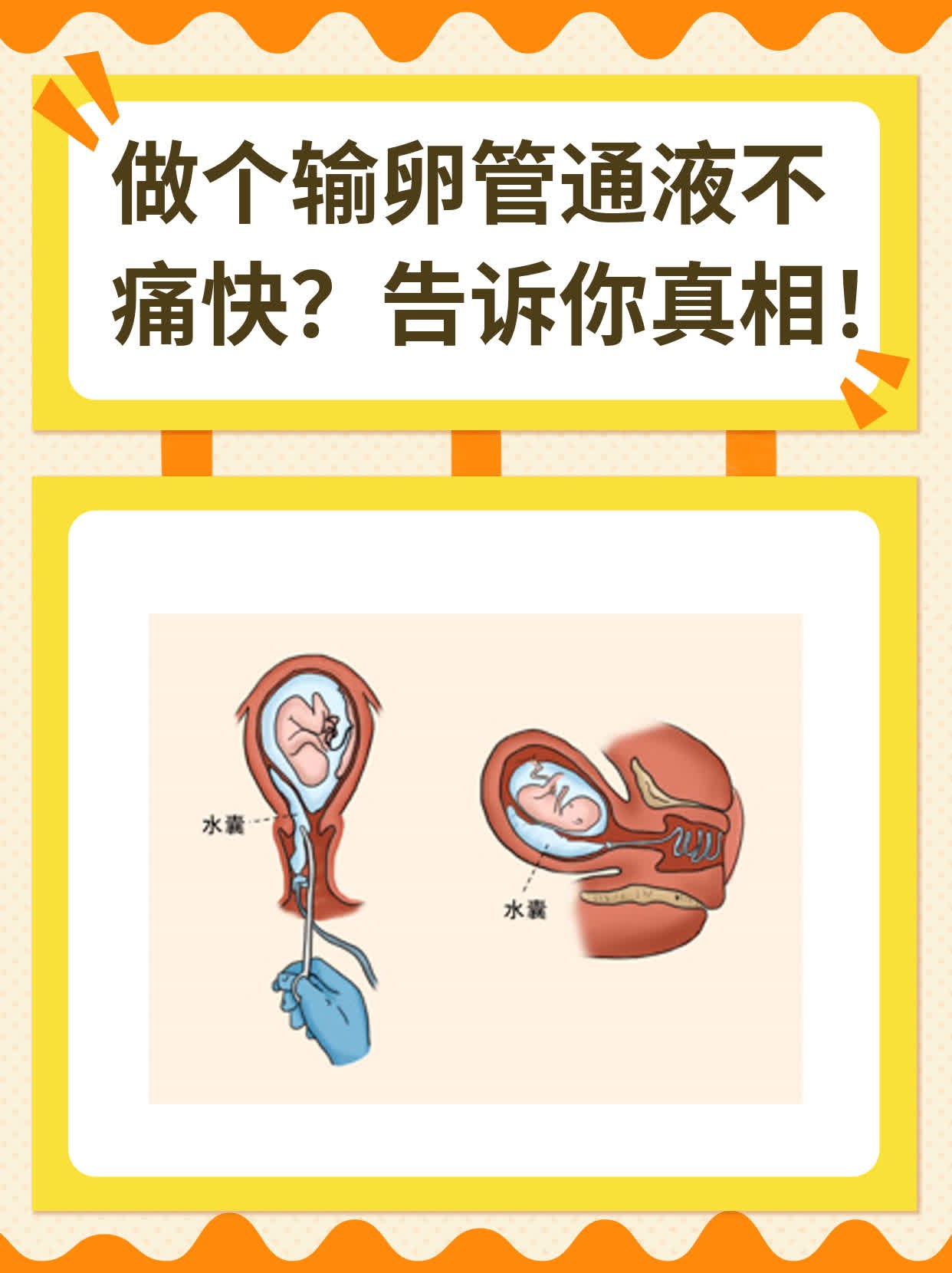 🥩做个输卵管通液不痛快？告诉你真相！🌟