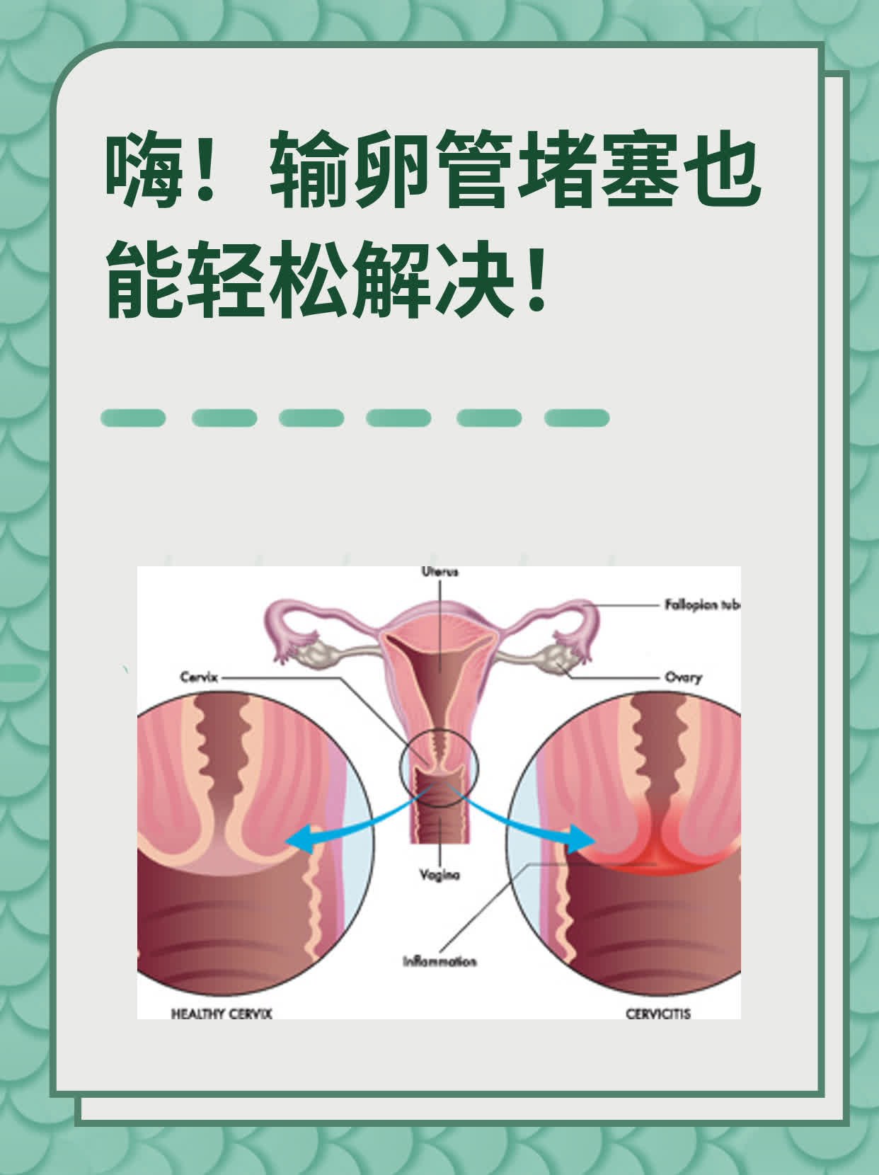 🏃嗨！输卵管堵塞也能轻松解决！❗️