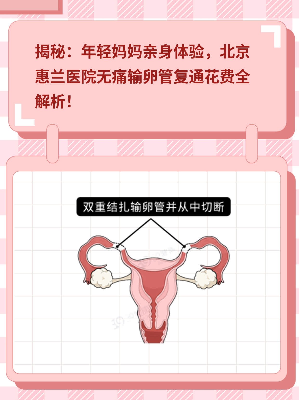 📈揭秘：年轻妈妈亲身体验，北京惠兰医院无痛输卵管复通花费全解析！🥊