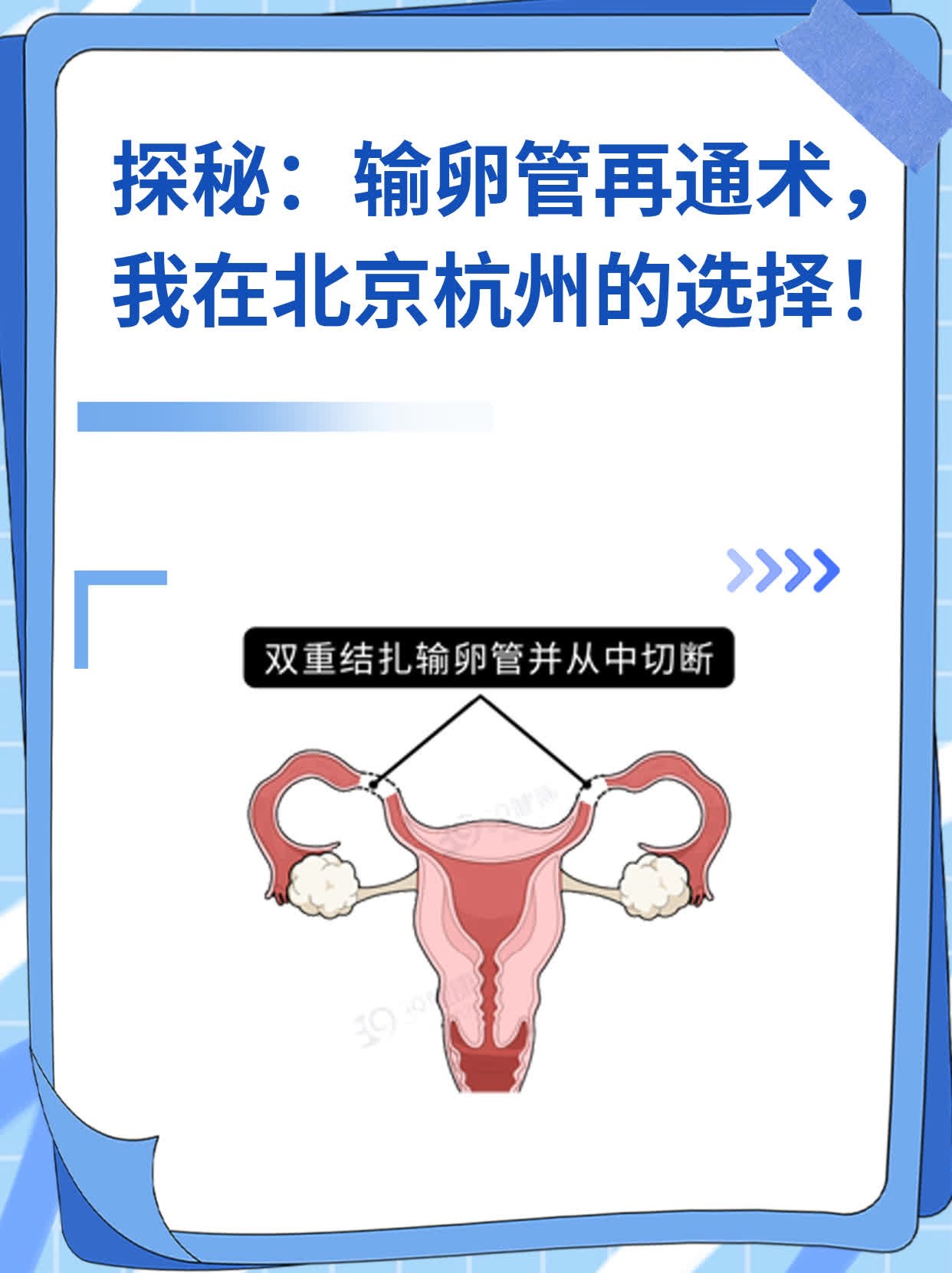 💖探秘：输卵管再通术，我在北京杭州的选择！📈
