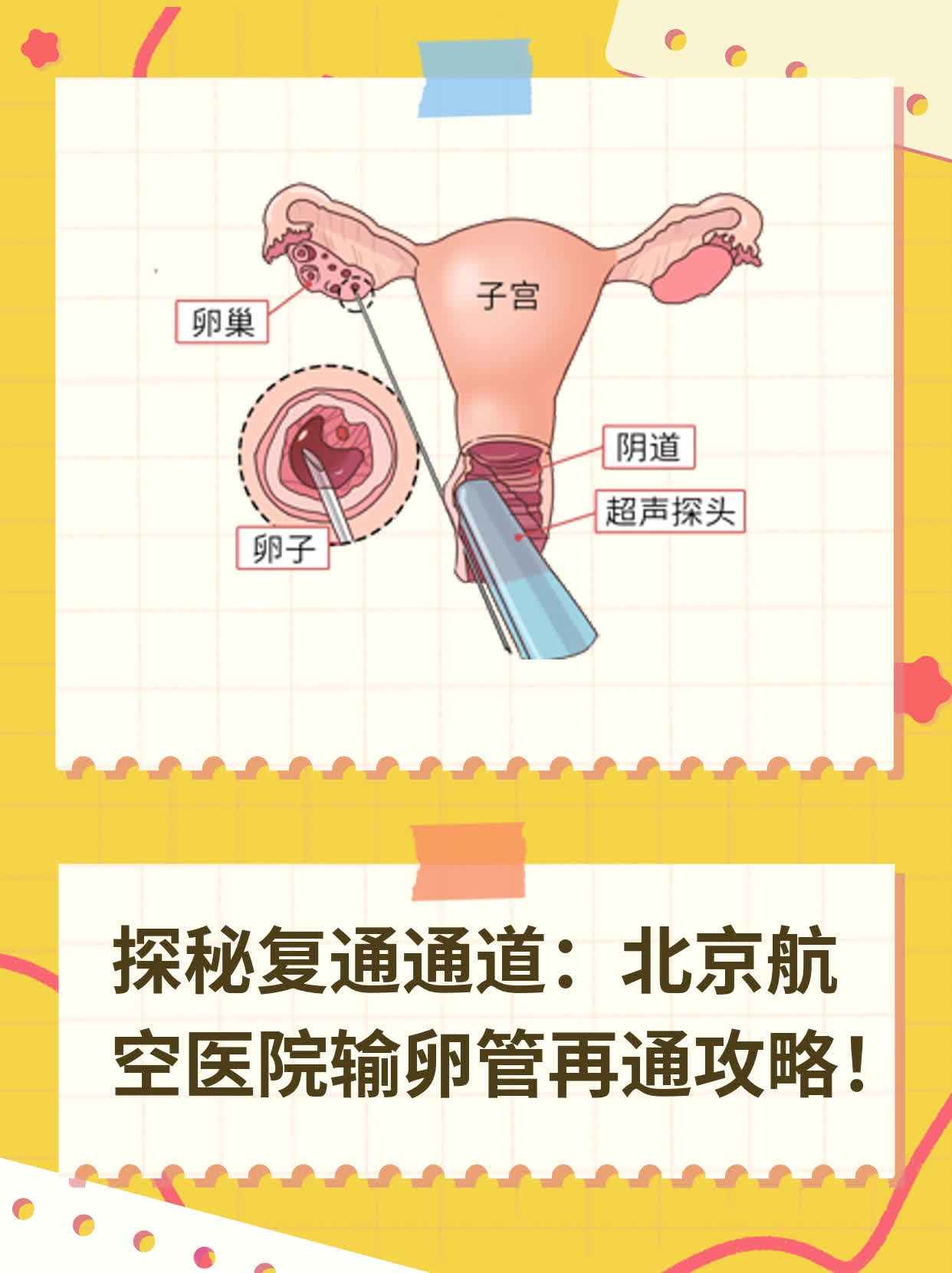 💖探秘复通通道：北京航空医院输卵管再通攻略！📈
