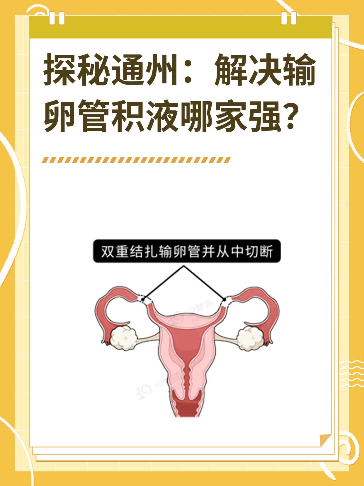 ❗️探秘通州：解决输卵管积液哪家强？✅