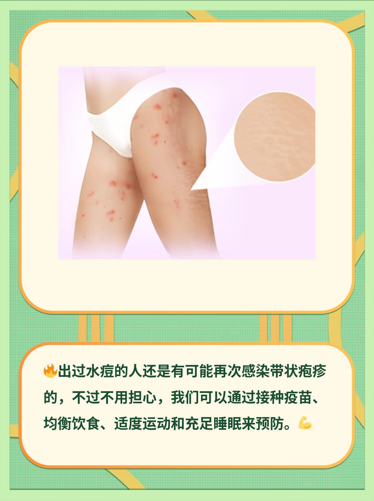 「你问过自己吗？」—— 出过水痘后还会长带状疱疹吗？