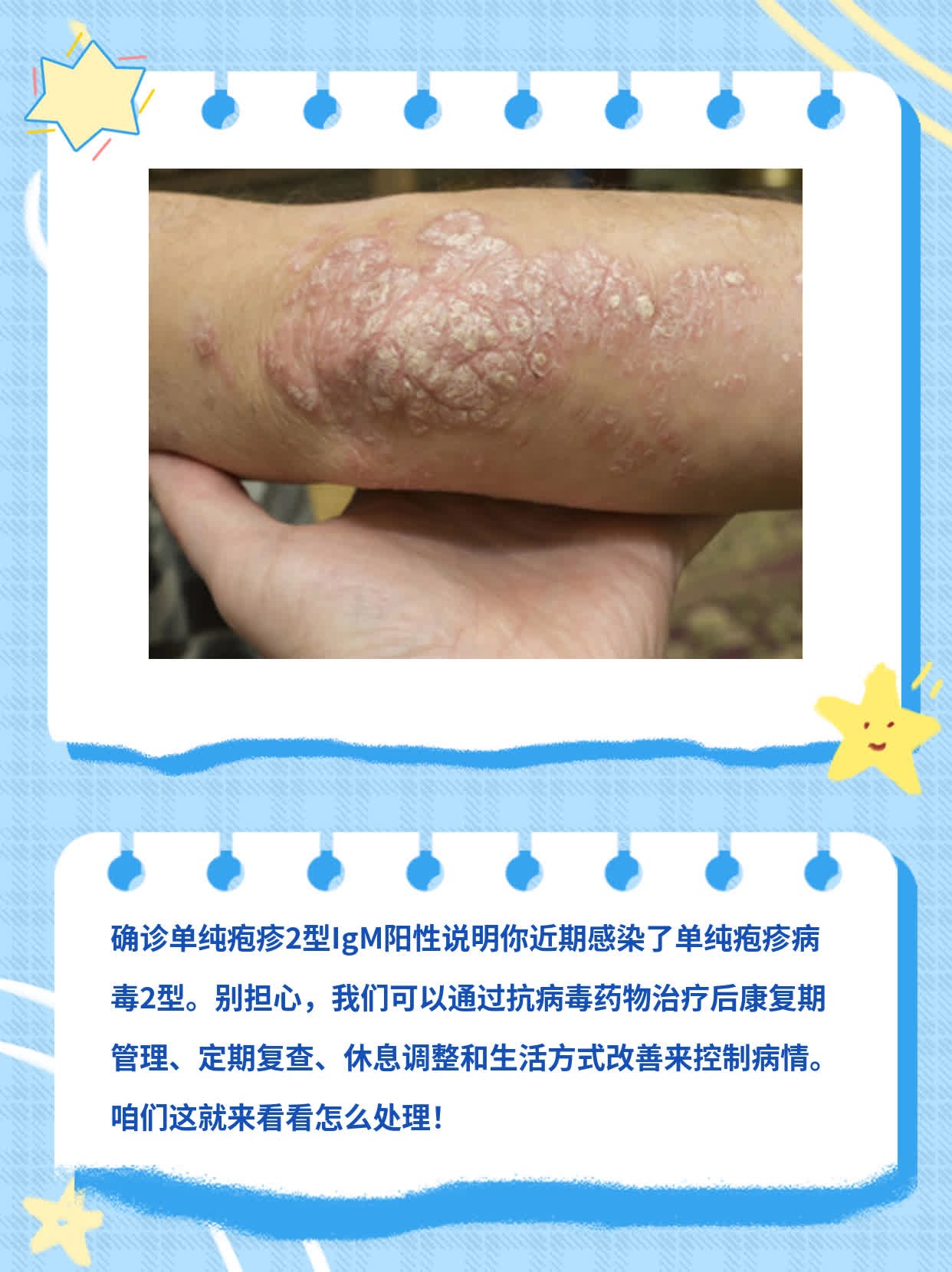 单纯疱疹2型IgM阳性：了解其意义！