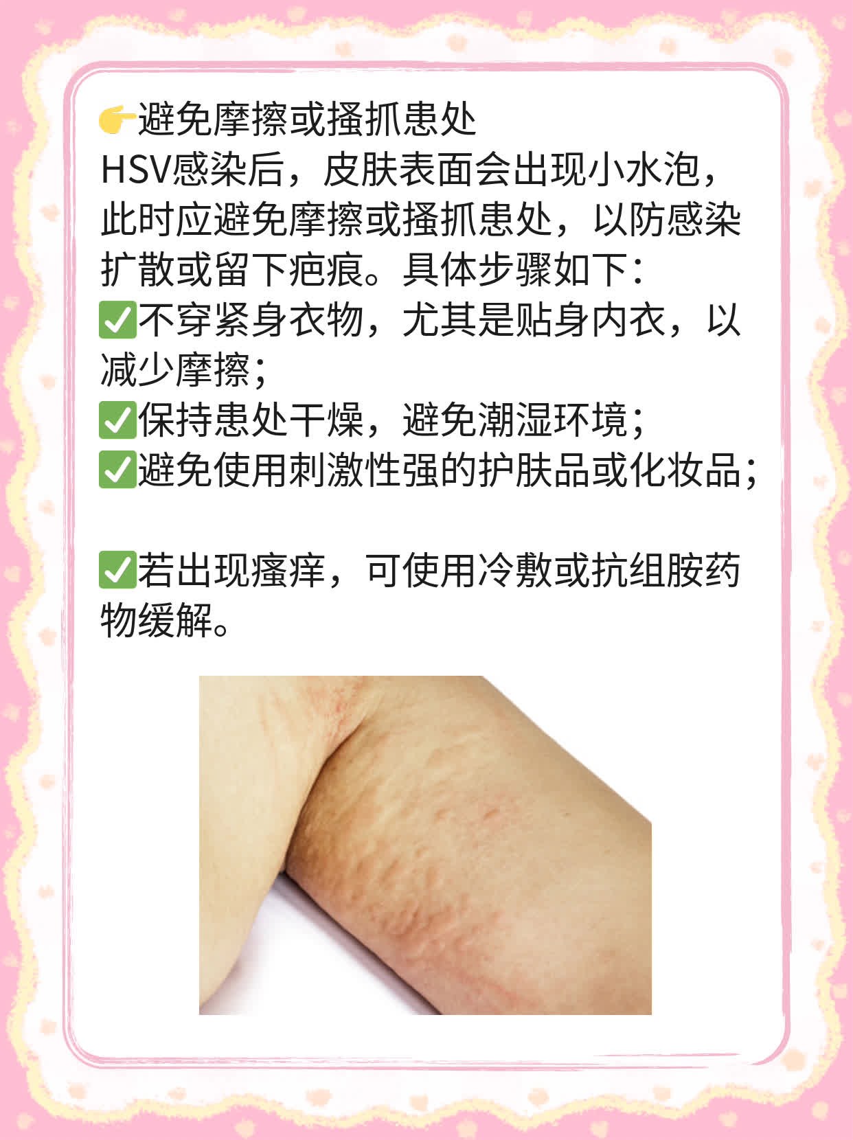 「经验分享」单纯疱疹病毒感染治疗妙招
