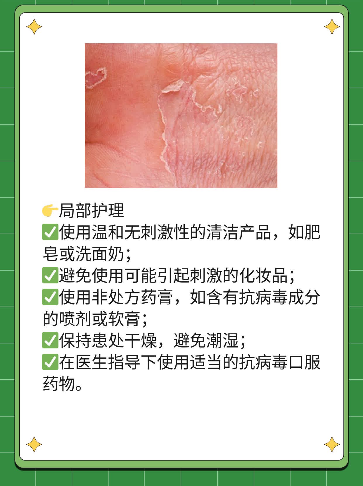 「答疑解惑」单纯疱疹病毒型的意思