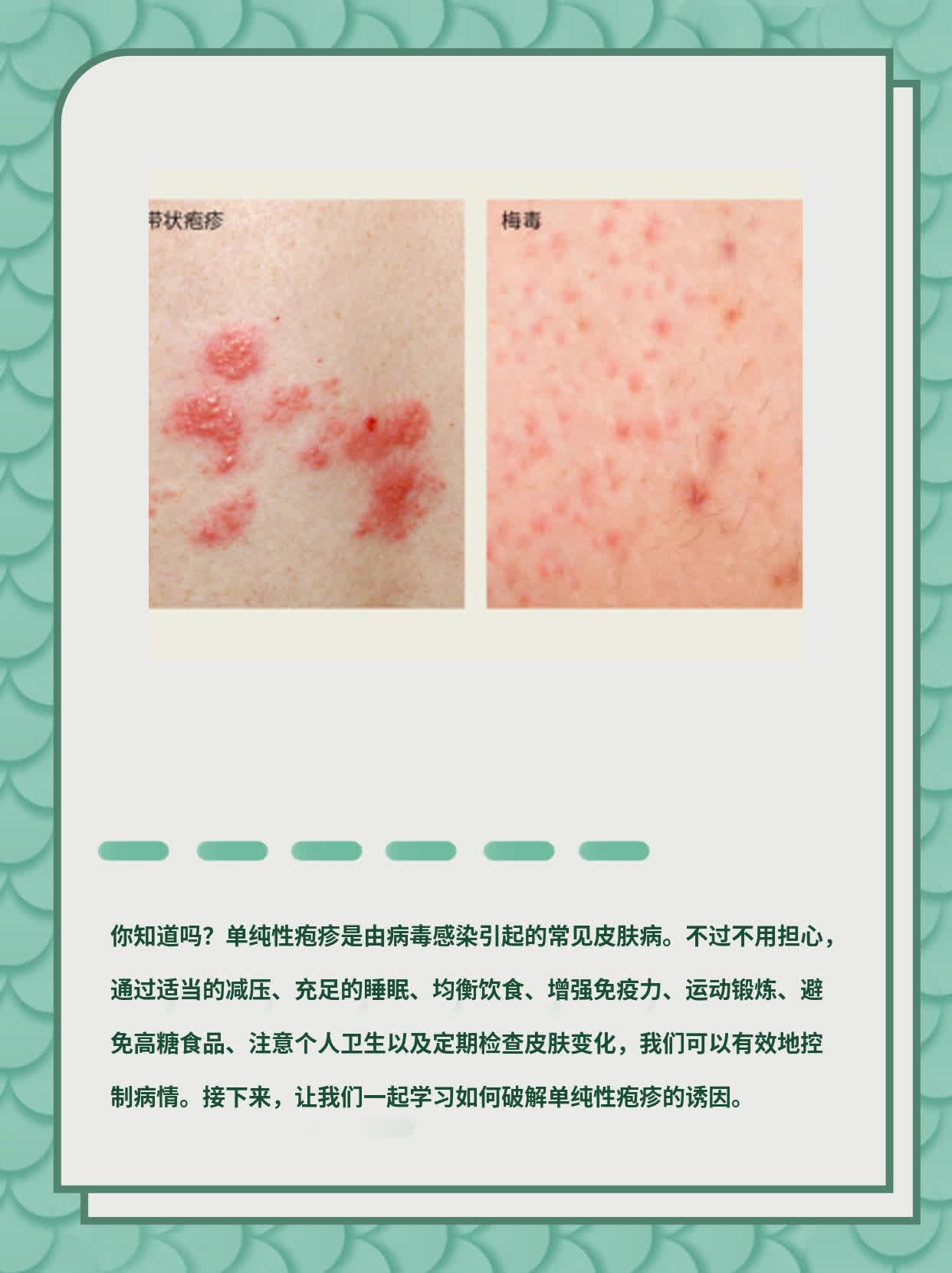 破解单纯性疱疹诱因：一份实用指南