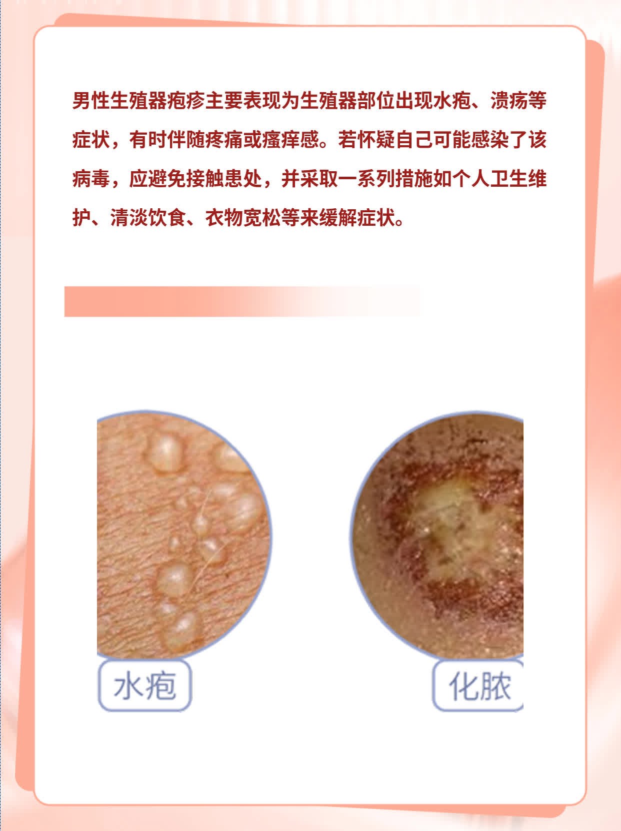 「有图有真相」：男性生殖器疱疹的表现大全