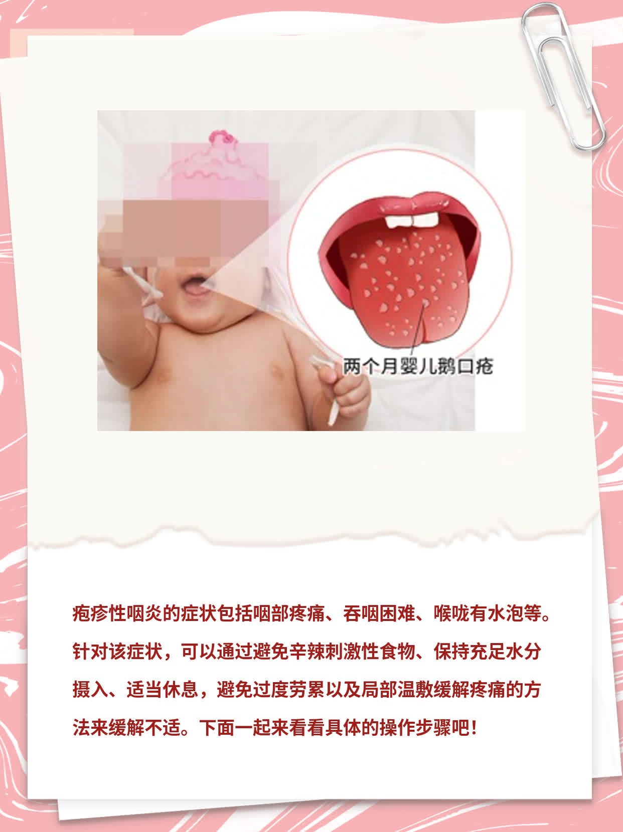 「咽炎有水泡」：症状+治疗