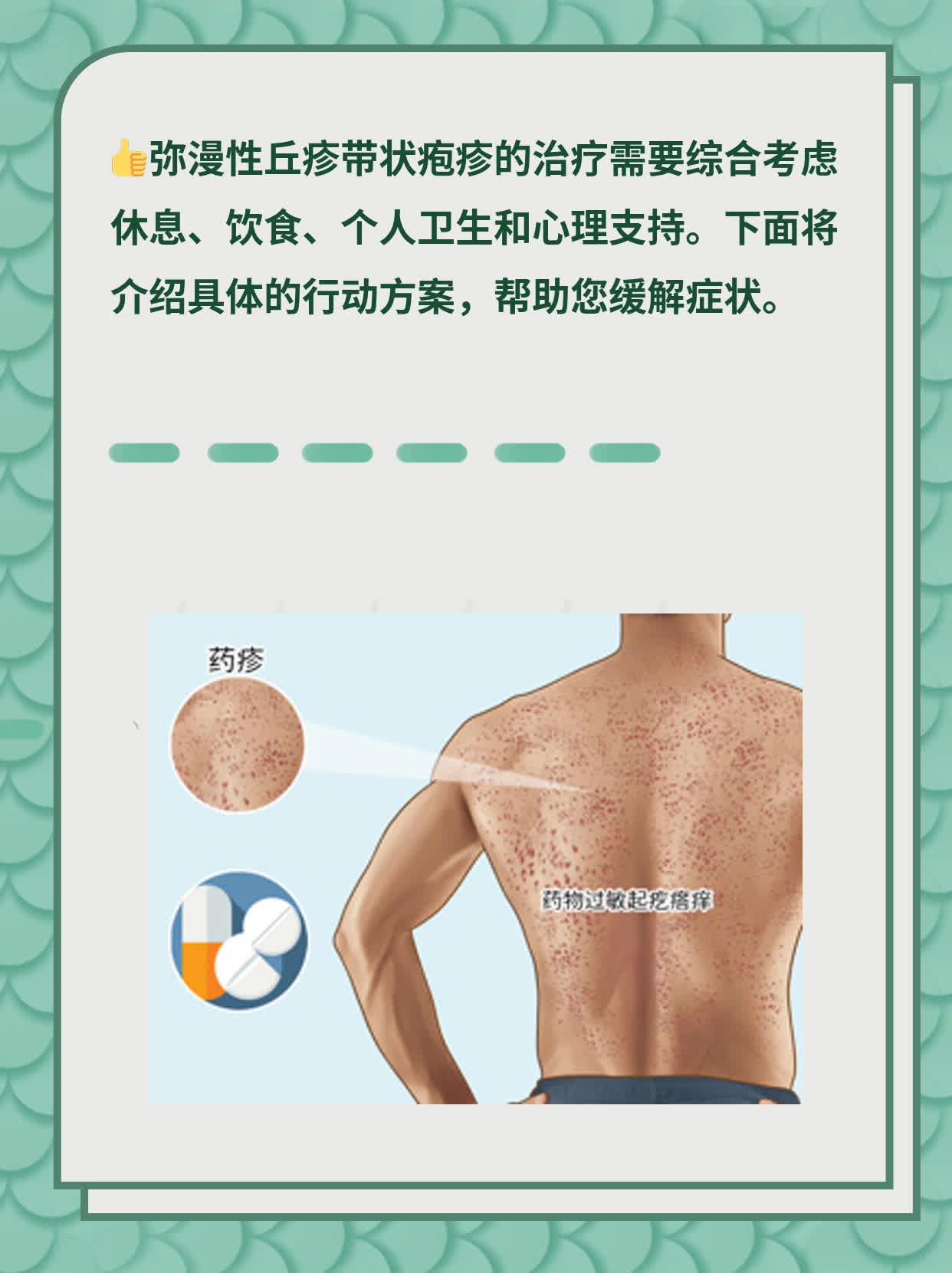 弥漫性丘疹带状疱疹治疗攻略