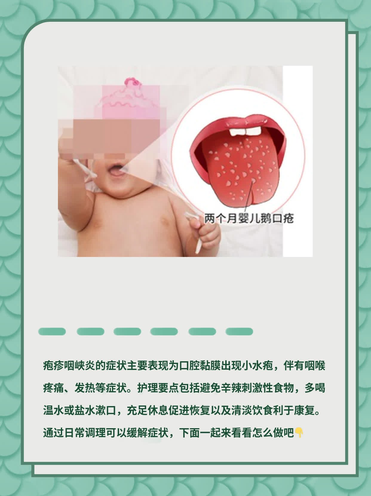 疱疹咽峡炎的症状及护理要点