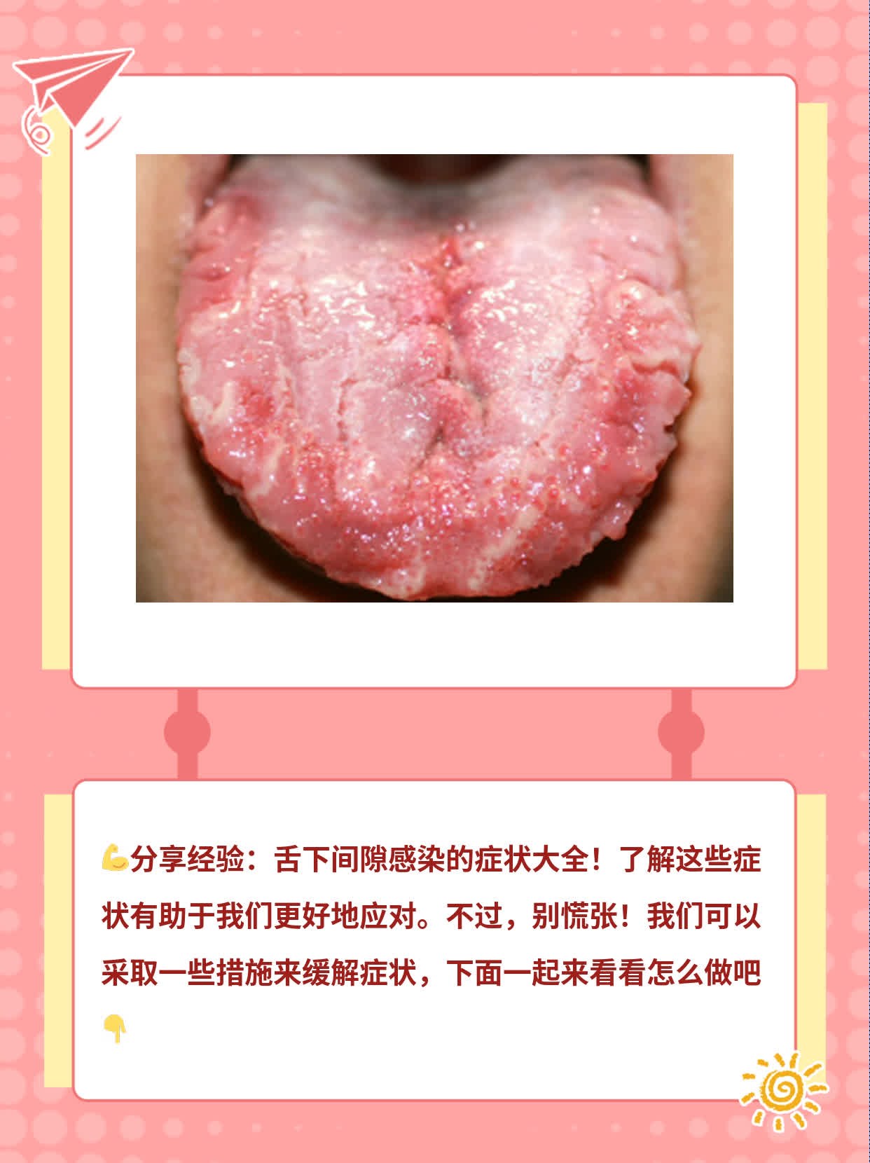 「分享经验」舌下间隙感染的症状大全