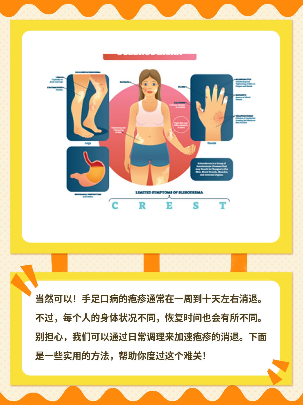 手足口病疱疹消退时间探秘