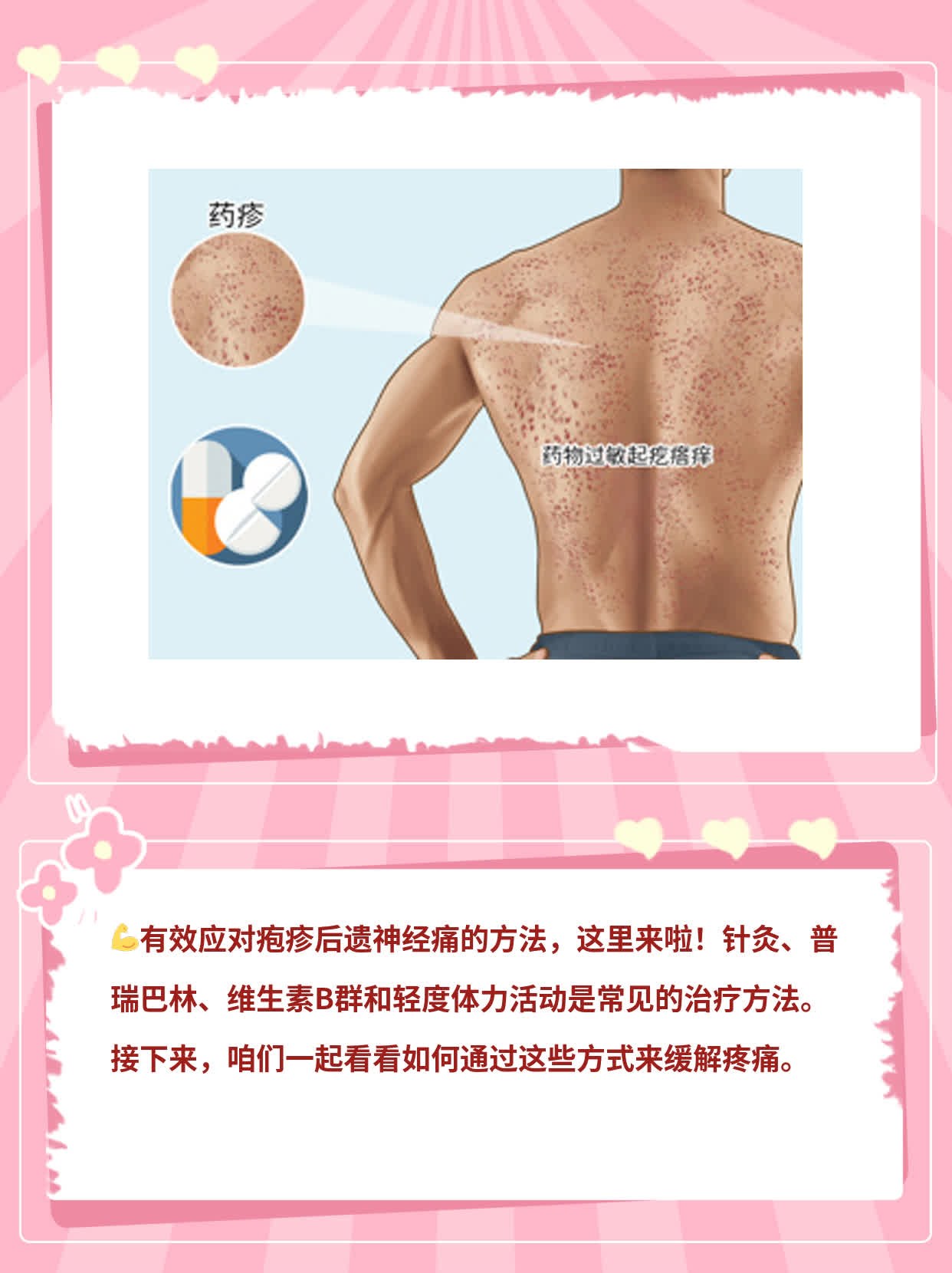 「摆脱神经痛」：战胜疱疹后遗症的方法