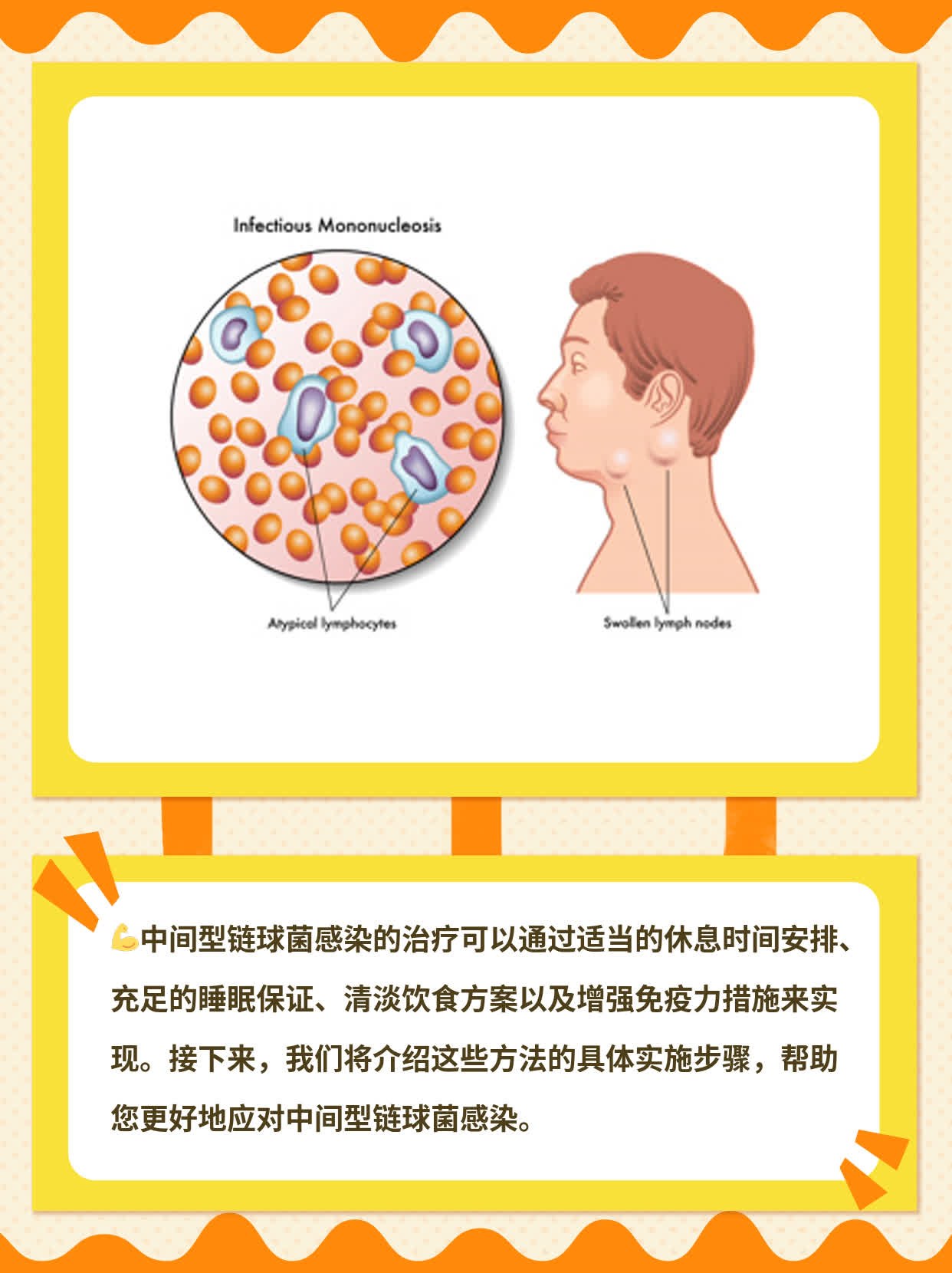 中间型链球菌感染治疗攻略