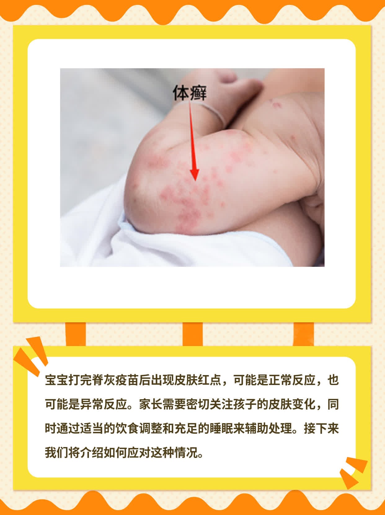 脊灰疫苗后宝宝皮肤红点：常见现象还是异常反应？