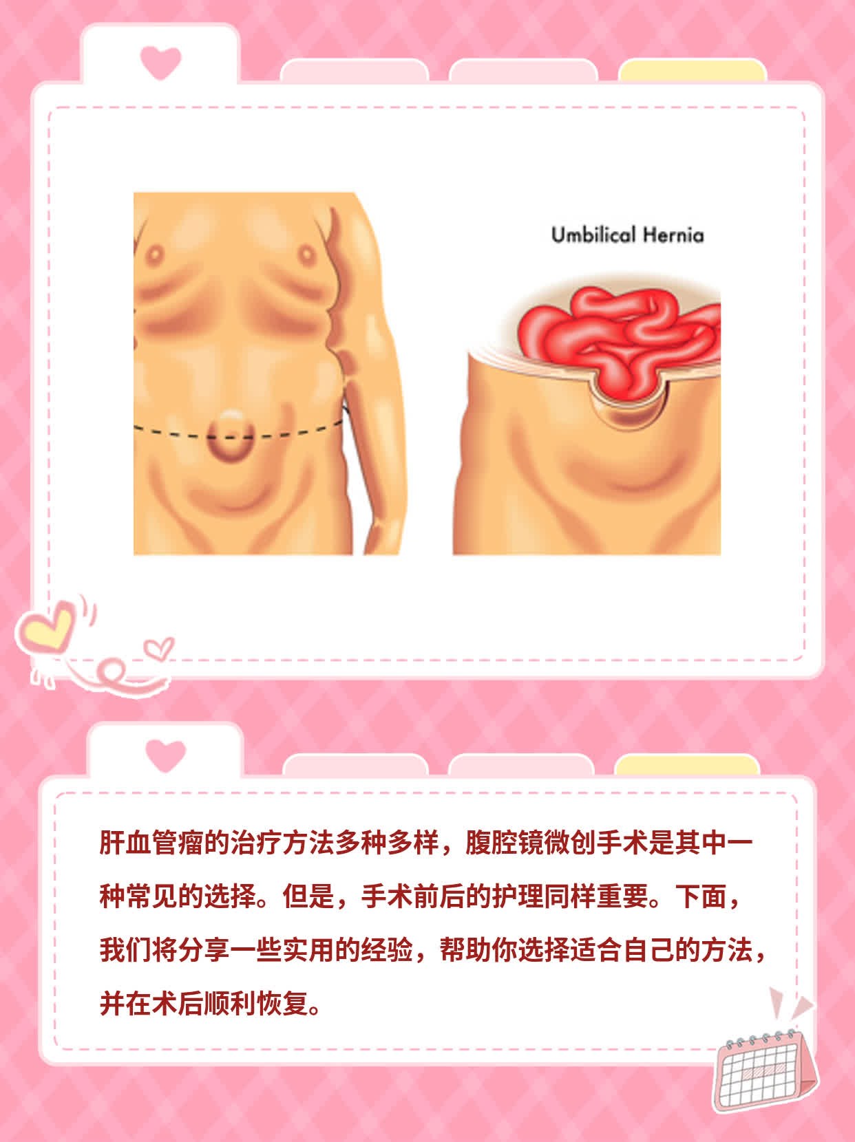 「肝血管瘤治疗」经验分享：选择适合你的方法！