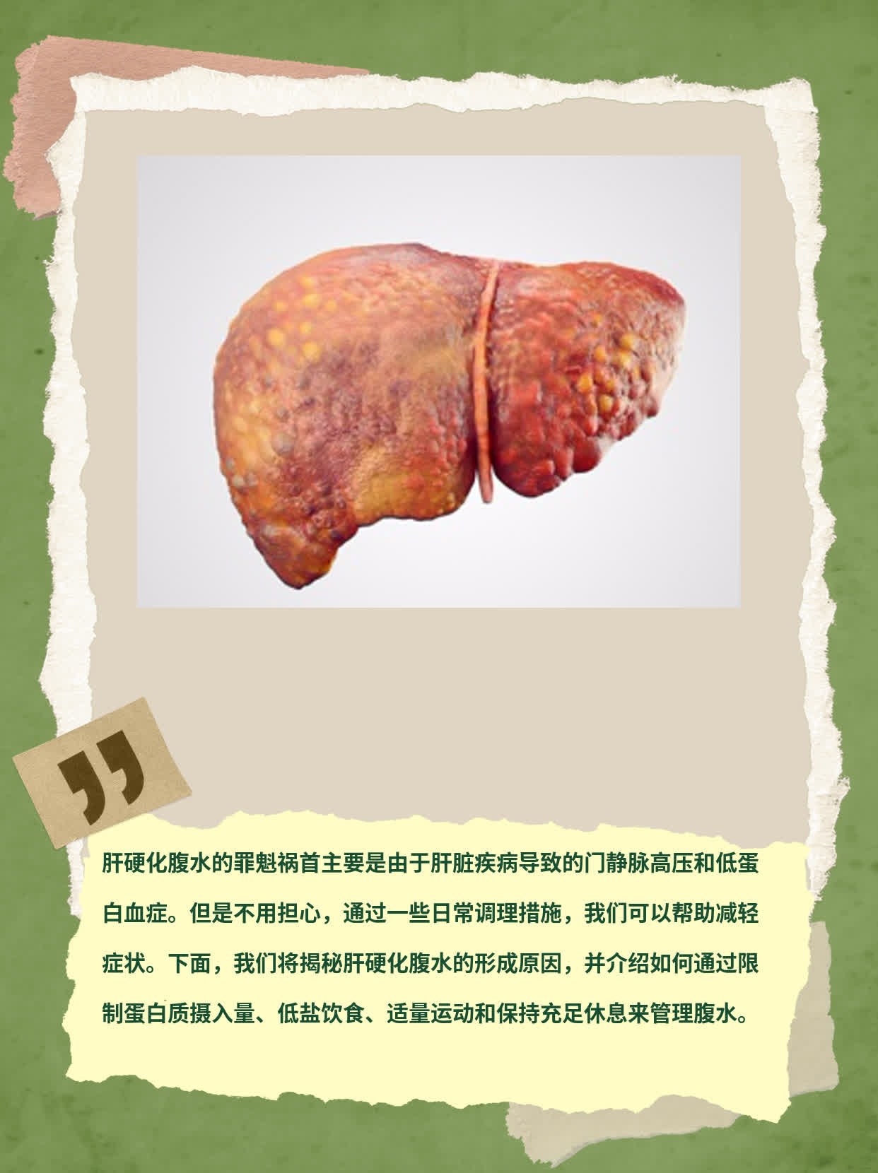 「揭秘」肝硬化腹水的罪魁祸首！