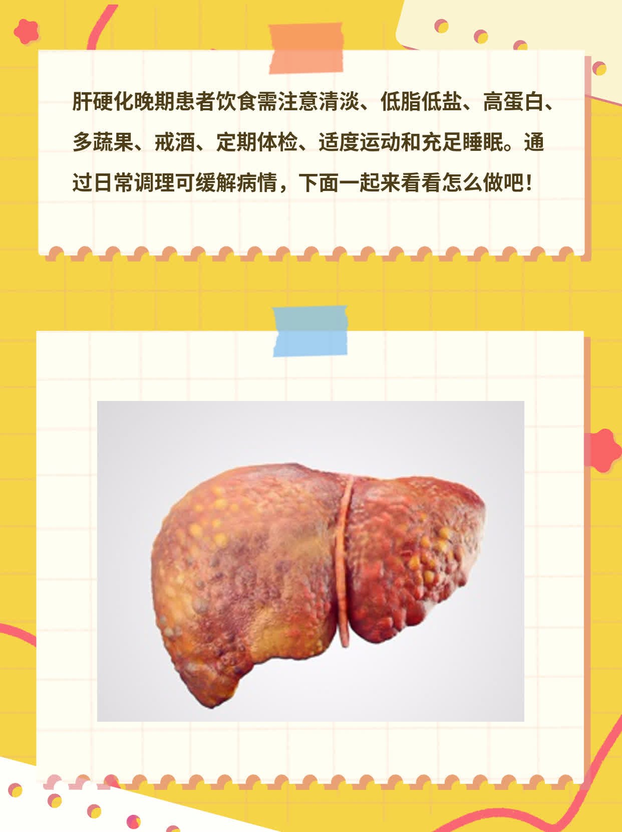 肝硬化晚期患者的饮食指南