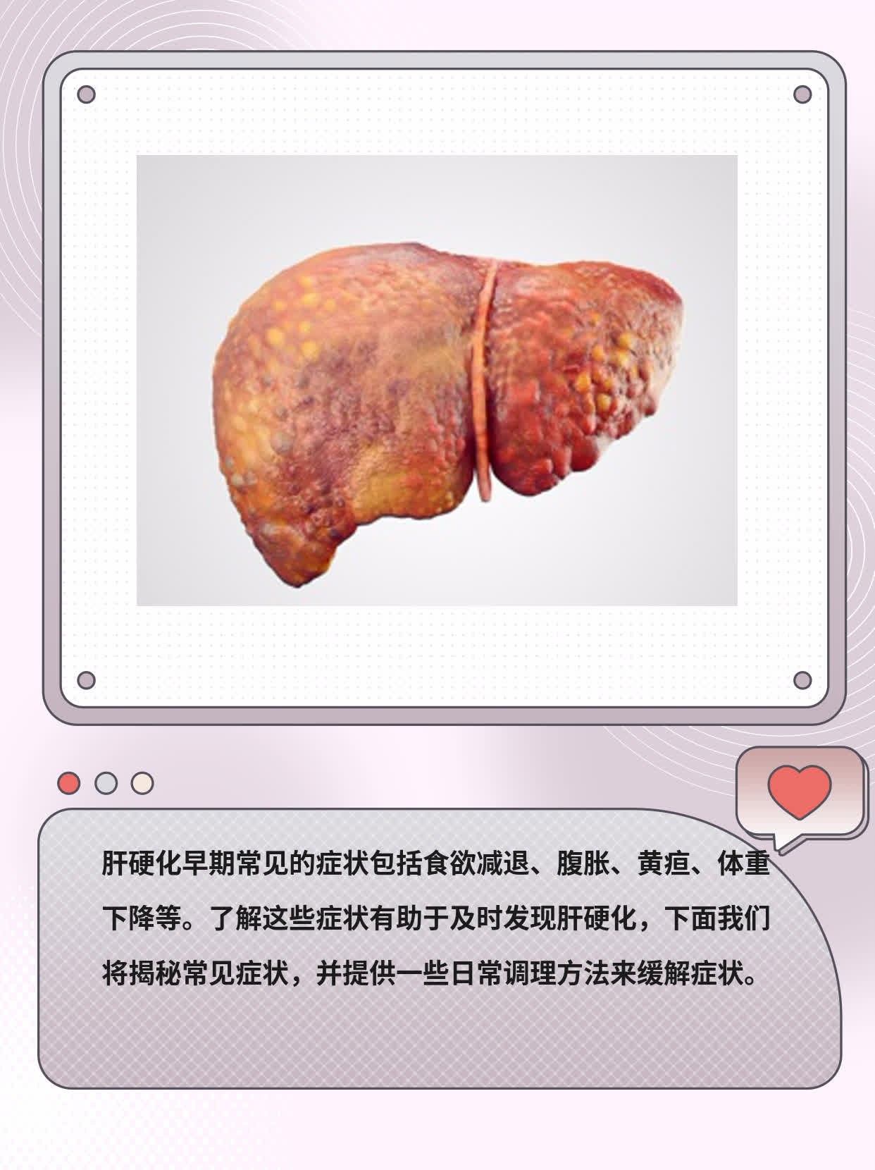 肝硬化的早期信号：揭秘常见症状！
