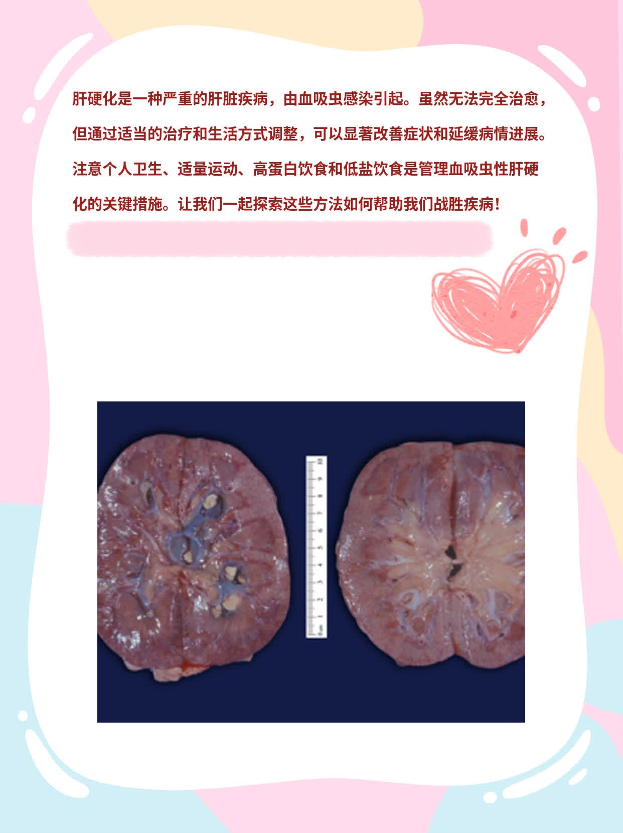 战胜血吸虫性肝硬化：治疗之路探索