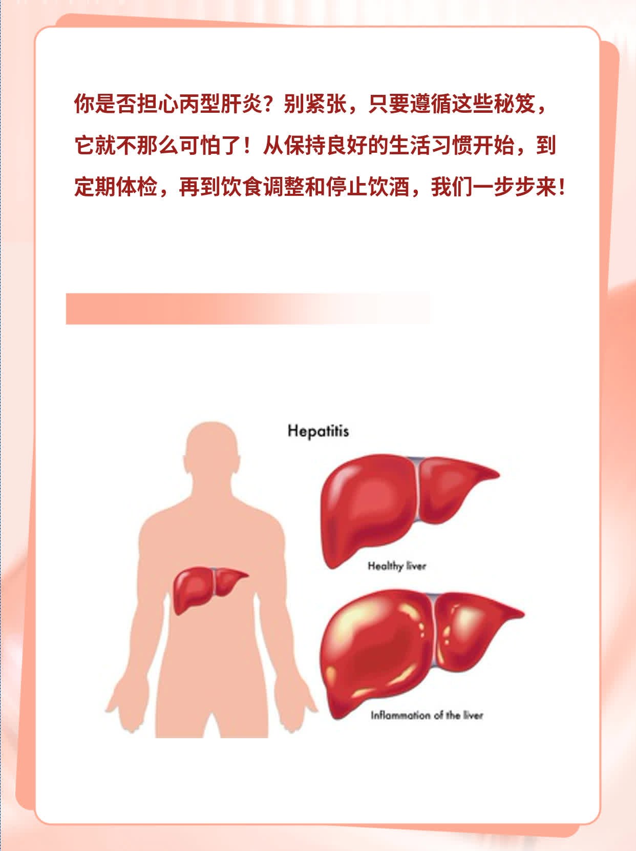 丙型肝炎：你需要知道的防治秘笈！