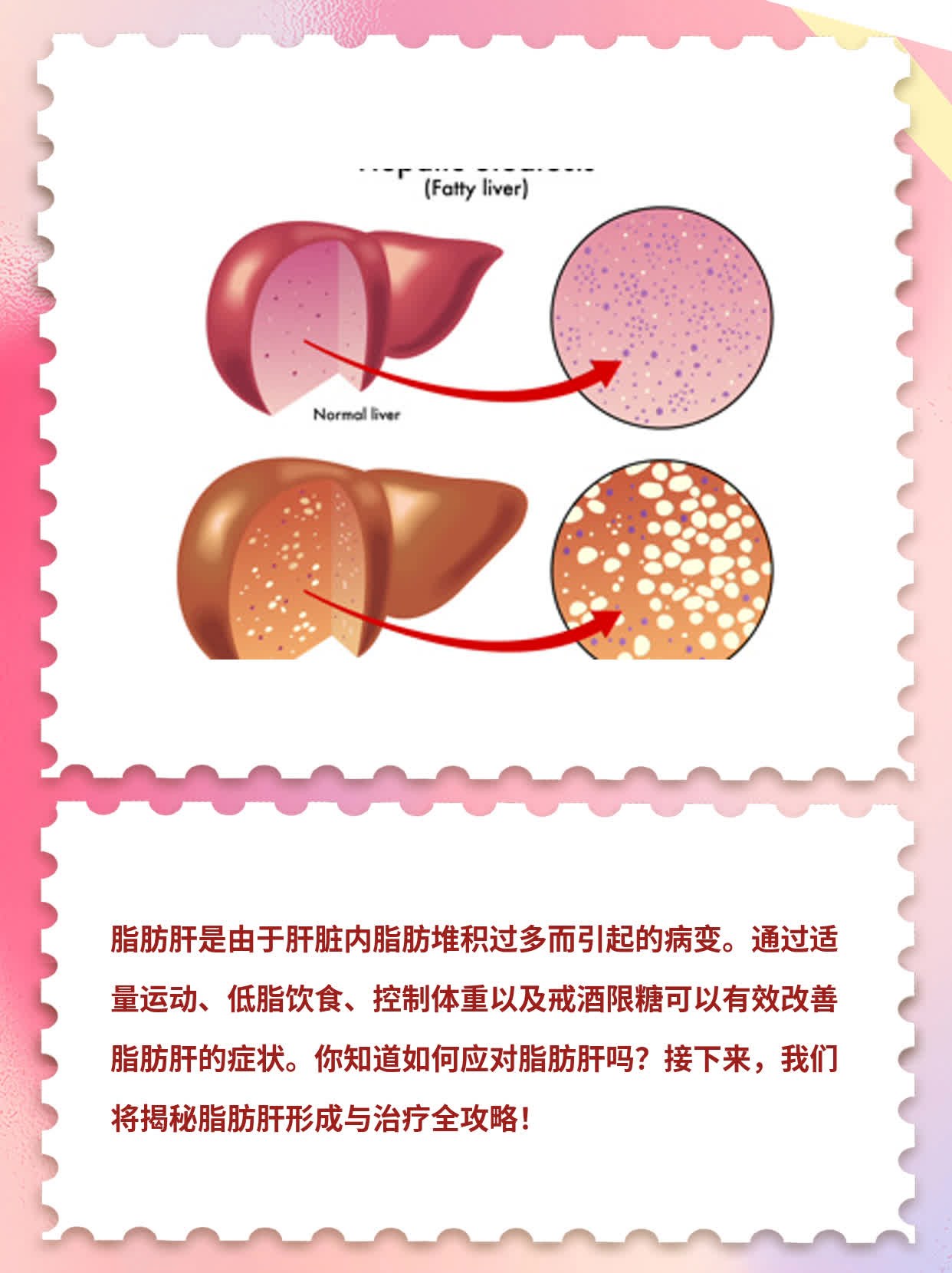 「揭秘」脂肪肝形成&治疗全攻略！