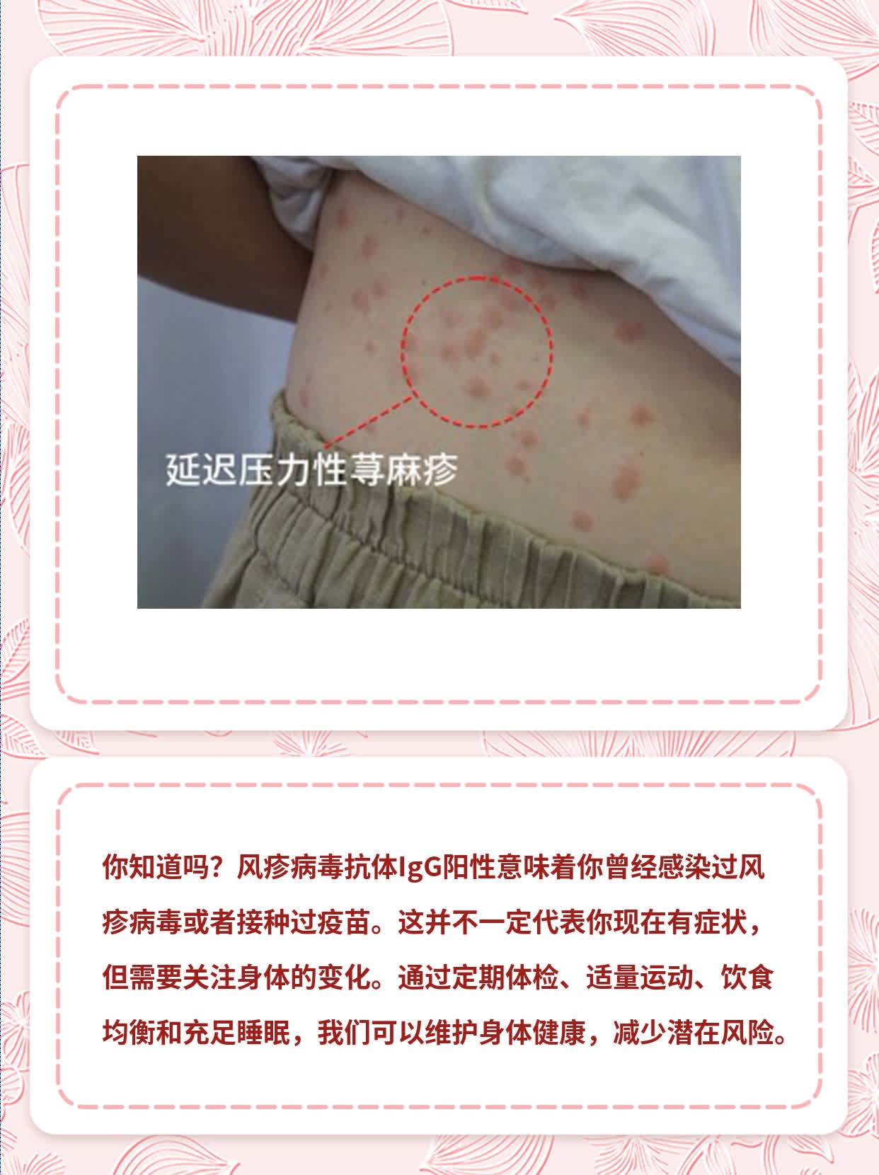 揭秘IgG阳性背后的秘密：风疹病毒抗体检测结果解析