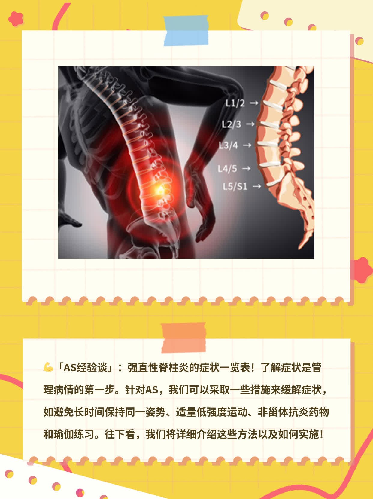 「AS经验谈」：强直性脊柱炎的症状一览表