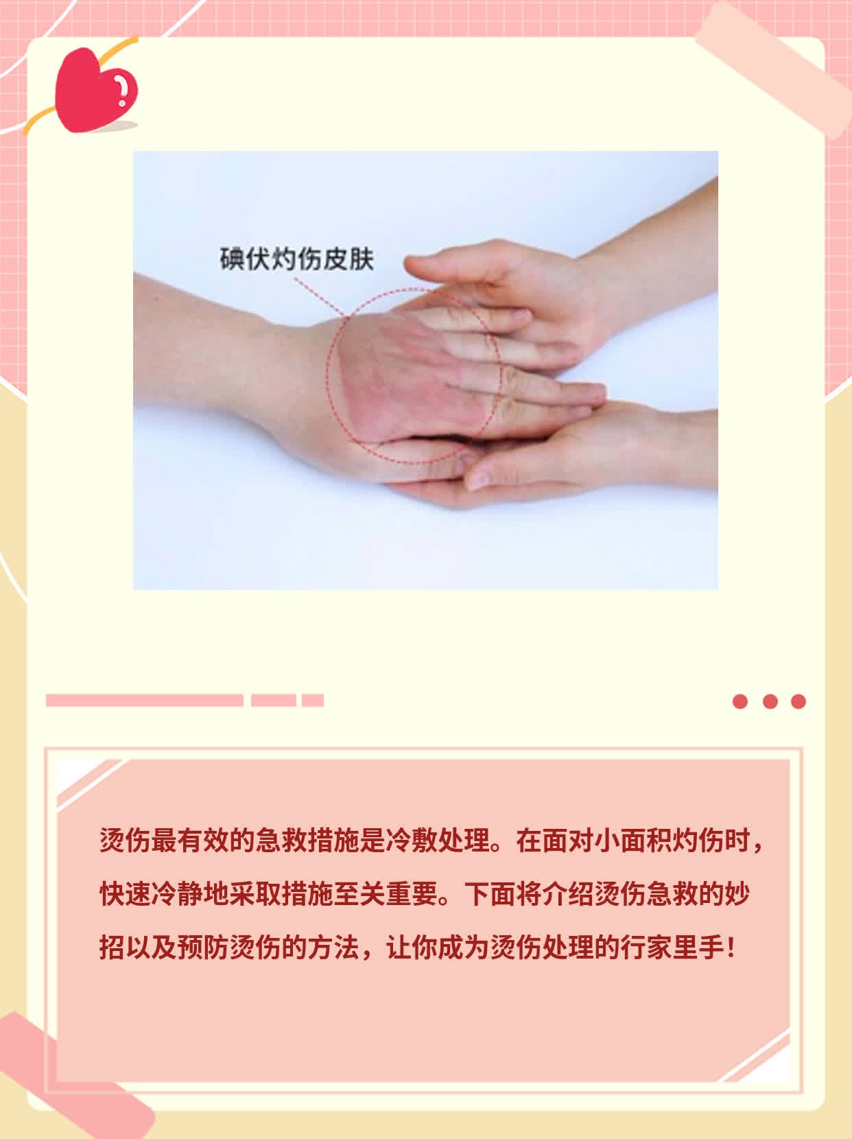 「烫伤急救」：快速处理小面积灼伤的妙招！