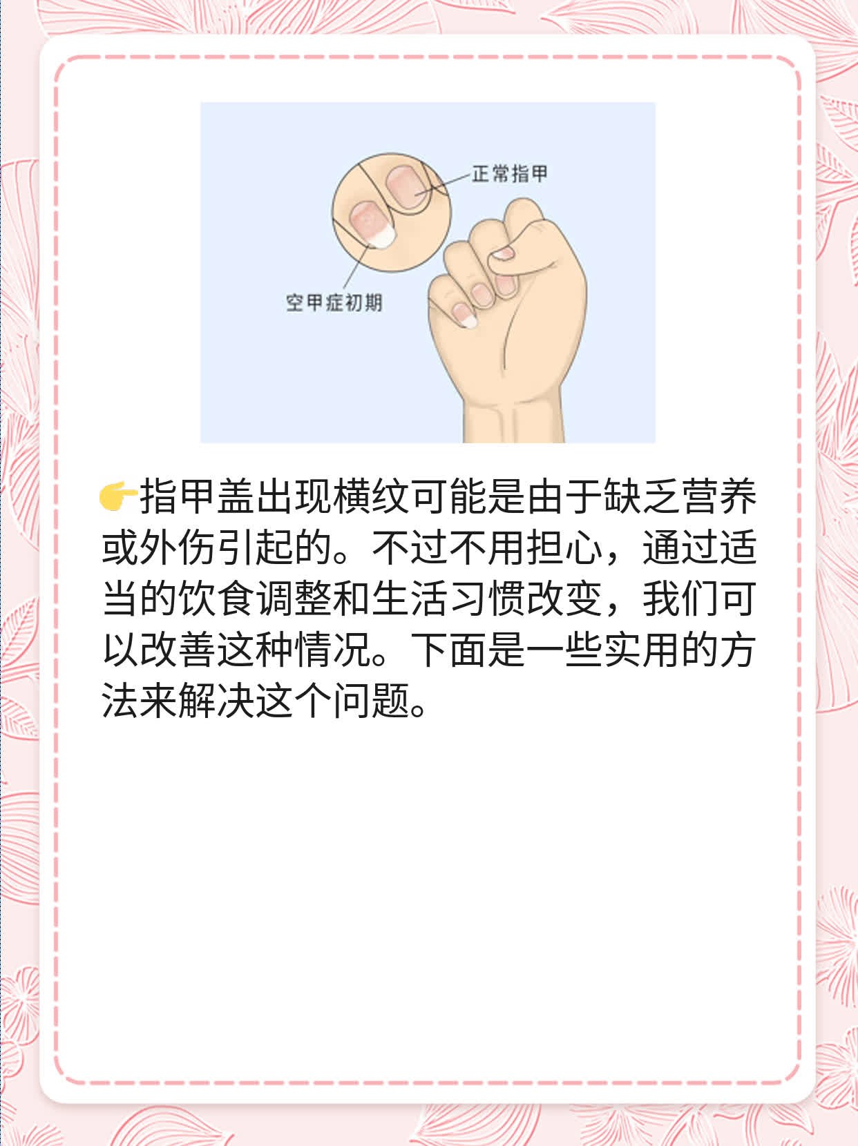 揭秘：指甲横纹原因！