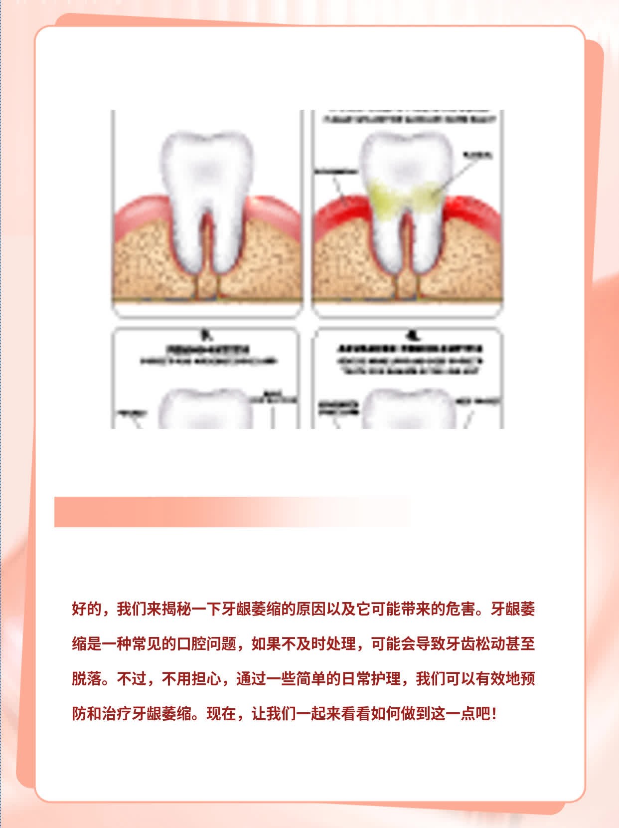 牙龈萎缩怎么回事图片