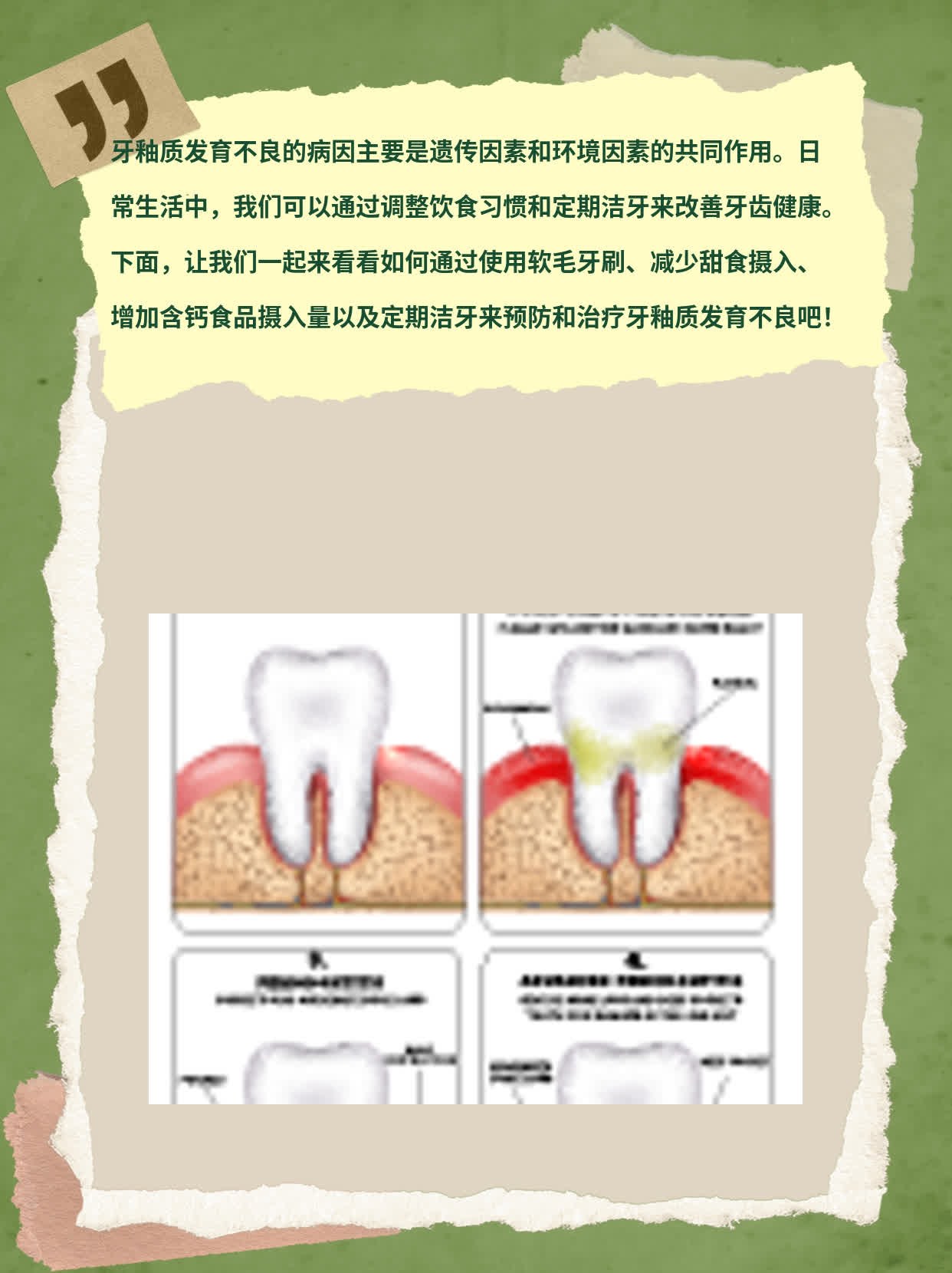 「牙釉质发育不良」防治秘笈：病因揭秘&解决方案！