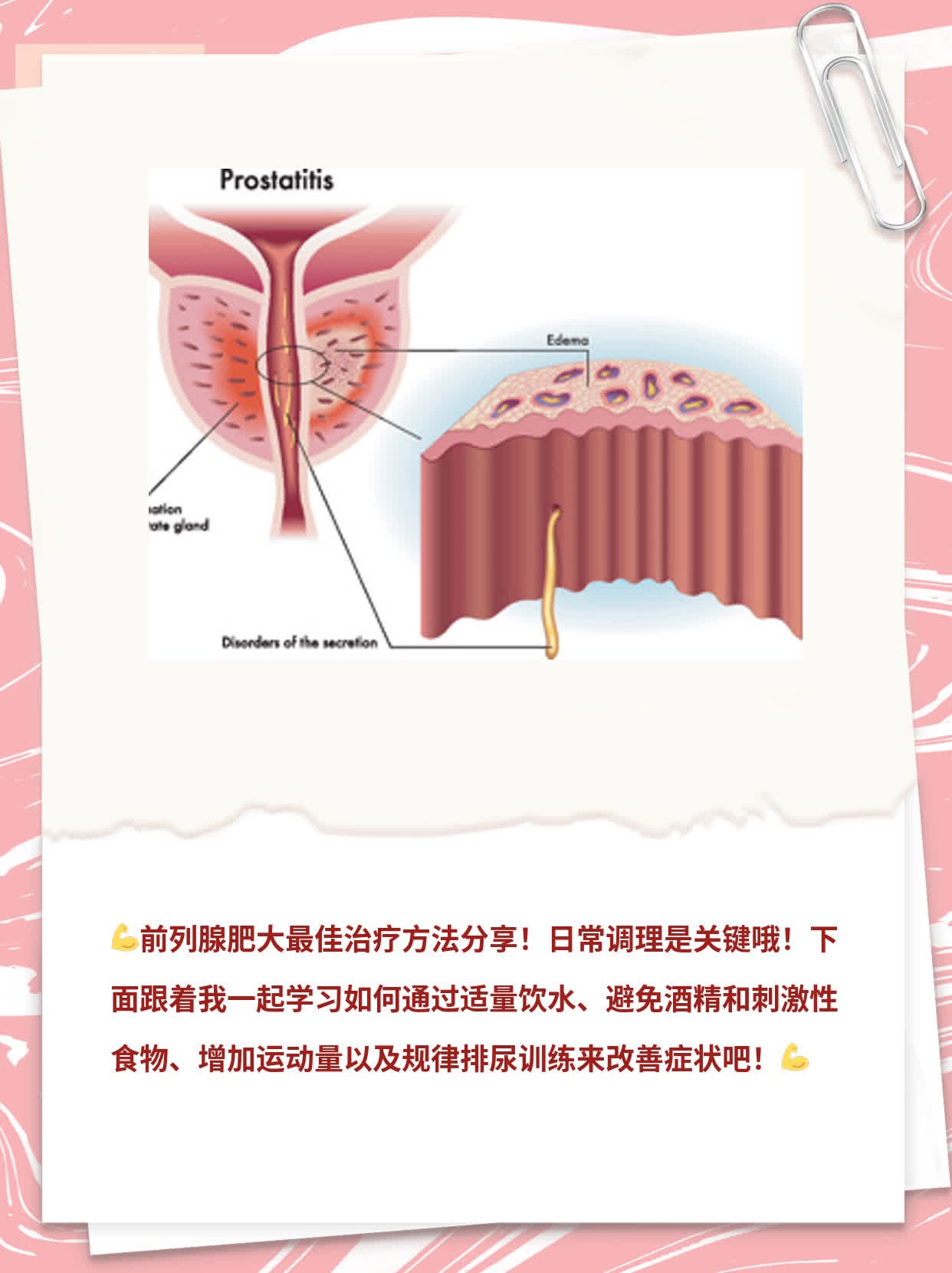 前列腺肥大最佳治疗方法分享