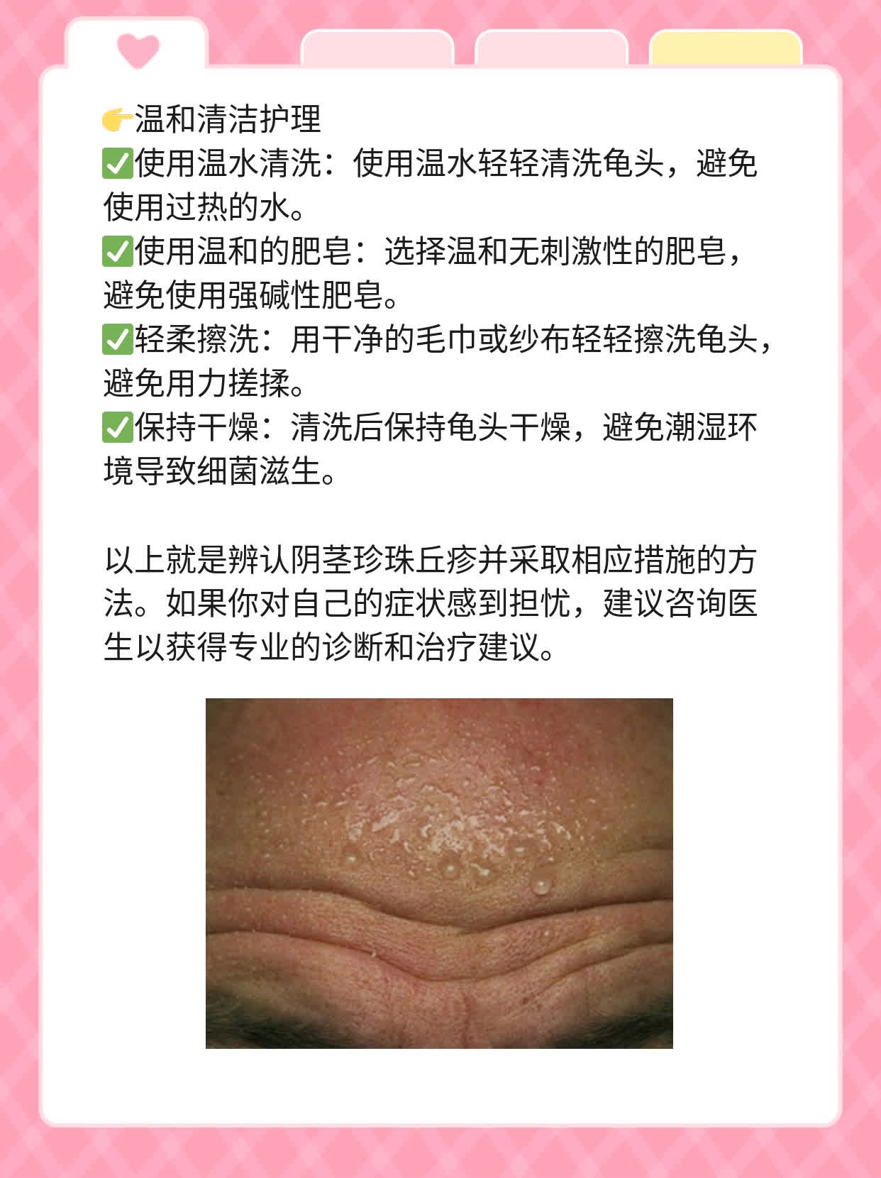 辨认阴茎珍珠丘疹：图解龟头症状